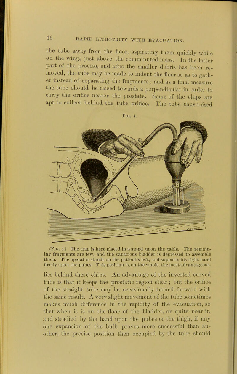 the tube away from the floor, aspirating thein quickly while on the wing, just above the comnnnute'd mass. In the latter part of the process, and after the smaller debris has been re- moved, the tube may be made to indent the floor so as to gath- er instead of separating the fragments; and as a final measure the tube should be raised towards a perpendicular in order to carry the orifice neai'er the prostate. Some of the chips are apt to collect behind the tube orifice. The tube thus raised Fig. 4. (Fig. 5.) The trap is here placed in a stand upon the tahle. The remain- ing fragments are few, and tlie capacious hladder is depressed to assemble them. The operator stands on the patient's left, and supports his right hand firmly upon the pubes. This position is, on the whole, the most advantageous. lies behind these chips. An advantage of the inverted curved tube is that it keeps the prostatic region clear; but the orifice of the straight tube may be occasionally turned forward with the same result. A very slight movement of the tube sometimes makes much difference in the rapidity of the evacuation, so that when it is on the floor of the bladder, or quite near it, and steadied by the hand upon the pubes or the thigh, if any one expansion of the bulb proves more successful than an- other, the precise position then occupied b}'- the tube should