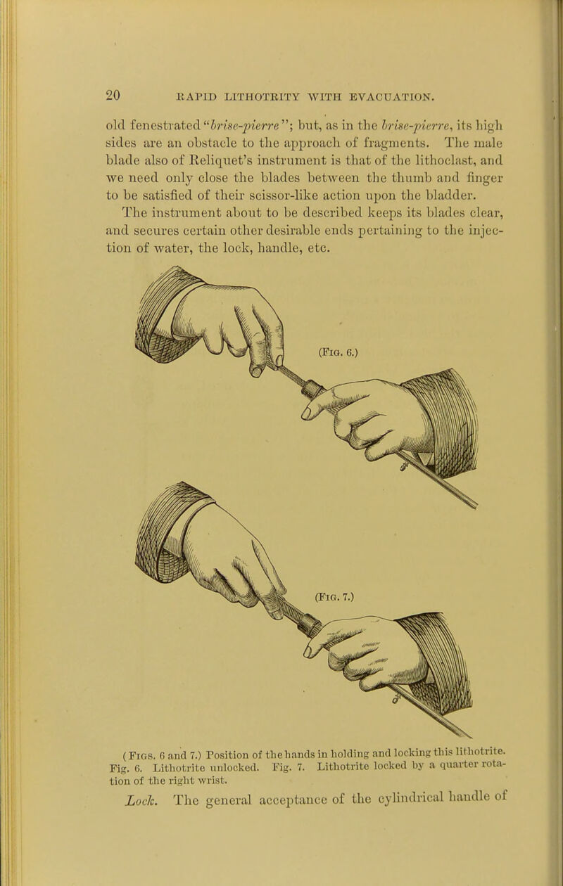 old fenestrated in'sf-pi'erre ; but, as in the hrise-pierre, its hif>h sides are an obstacle to the approach of fragments. Tlie male blade also of Reliquet's instrument is that of the lithoclast, and we need only close the blades between the thumb and finger to be satisfied of their scissor-like action upon the bladder. The instrument about to be described keeps its blades clear, and secures certain other desirable ends pertainiiig to the injec- tion of water, the lock, handle, etc. ( Figs. 6 and 7.) Position of tliehands in holding and locking this liUiotrite. Fig. 6. Lithotrite unlocked. Fig. 7. Lithotrite locked by a quarter rota- tion of the right wrist. LocJc. The general acceptance of the cylindrical handle of