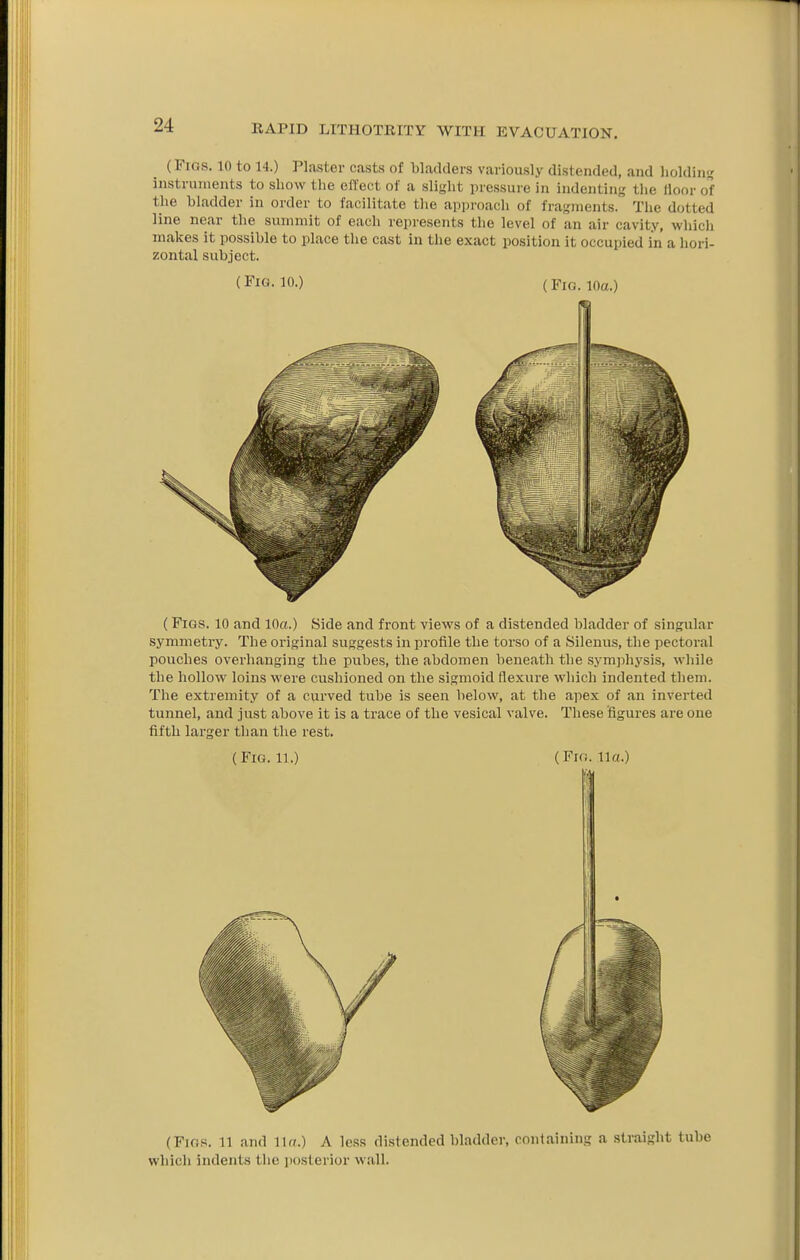 (Figs. 10 to 14.) Plaster casts of bladders variously distended, and lioldintc instruments to show tlie efteet of a slight pressure in indenting the floor of the bladder in order to facilitate the approach of fragments. The dotted line near the summit of each represents the level of an air cavity, which makes it possible to place the cast in the exact position it occupied in a hori- zontal subject. (Fig. 10.) (Fig. 10a.) ( Figs. 10 and 10a.) Side and front views of a distended bladder of singular symmetry. The original suggests in profile the torso of a Silenus, the pectoral pouches overhanging the pubes, the abdomen beneath the symphysis, while the hollow loins were cushioned on the sigmoid flexure which indented them. The extremity of a curved tube is seen below, at the apex of an inverted tunnel, and just above it is a trace of the vesical valve. These figures are one fifth larger than the rest. (Fig. 11.) (Fifi. Ua.) (FiG.'5. 11 and 11«.) A less distended bladder, containing a sti-aight tube which indents the posterior wall.