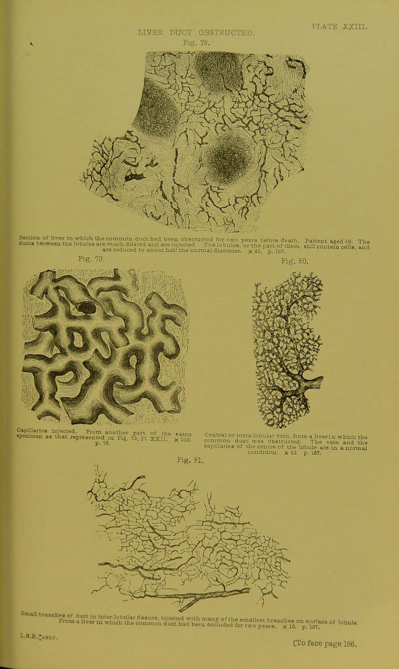 Section of Uver in which the common duct had been obstructed for two years before death. Patient aSed 40 The ducts between the lobules are much dilated and are injected Toe lobulee, or tbe part of them, still contain cells and are reduced to about half the normal diameter, nib. p. 1B7. ' Fig. 79. Kig. 60. W.Hi I. .. -^'V •• speoil^^'la^Sfat repieJe'^^Sd^n Fj^ 76^ PI XXT?* l^^? Central or iotra lobuU. vein, from a liverin which the p 76 ■ ^^'■i- X 21S. common duct was obstructed. The vein and the •^Pillanea of the centre of the lobule are in a normal condition, x 42. p. 187. Fig- 61. B.,nbra.ch«.du.in...^uj^^ 1-8.B. -LJtLT.