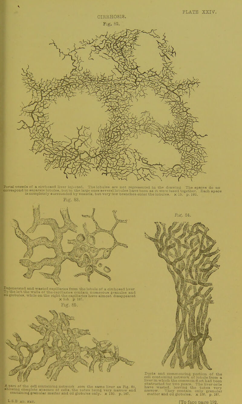 PLATE XXIY. CIRRHOSIS. Pig. 52. \ rtal vessels of a cirrhosefl liver inj.-cted. The lobules ai-e not represaoted in the drawinft The spaces do no rrespoDd to separate lobules, but lu the large ones several lobules have been as it were iusel together. Each space is completely surrounded by vessels, but very few branches enter the lobules, x If*, p. 193. Fag. 63. Fis;. 84. generated and wasted capillaries from the lobule of a cinhosed liver o the lett the Mvalls of the capillaries contain numerous (granules and globules, while on the right the capillaries have almost disappeared X 2iS. p 187. Fig. 65. V. 11 irL of the C' ■vin% cornpl 'Jutaiuiug g L 3.B AU. MAT •U contttininii network lom the same liver as Fi4. 81, eto abHeoco of colls, the tubes being very narrow ond rauular matter and oU globules only, x 130. p. la7. Ducts and commouciu^ portion of the cell contiilnlni) uoUvork of lobule from a liver in which lha common d ict had been obNtriictod for two years. 'The liver cqUh have wasted, loaviuft the tubes very narrow. 'I hey contain only granular niallor and oil globules, x ISO. p. 187. FTo face Dai^e 192.