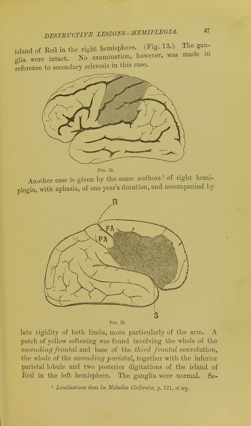 island of Eeil in the right hemisphere (Fig. 13.) The gan- glia were intact. No examination, however, was made m reference to secondary sclerosis in this case. Fio. 12. Another case is given by the same aiithors > of right hemi- plegia, with aphasia, of one year's duration, and accompanied by Fio. 13. late rigidity of both limbs, more particularly of the arm. A patch of yellow softening was found involving the whole of the ascending frontal and base of the third frontal convolution, the whole of the ascending 'parietal, together with the inferior parietal lobule and two posterior digitations of the island of Eeil in the left hemisphere. The ganglia were normal. Se- ' Localisations dans Ics Maladies CMbrales, p. 121, ct scq.