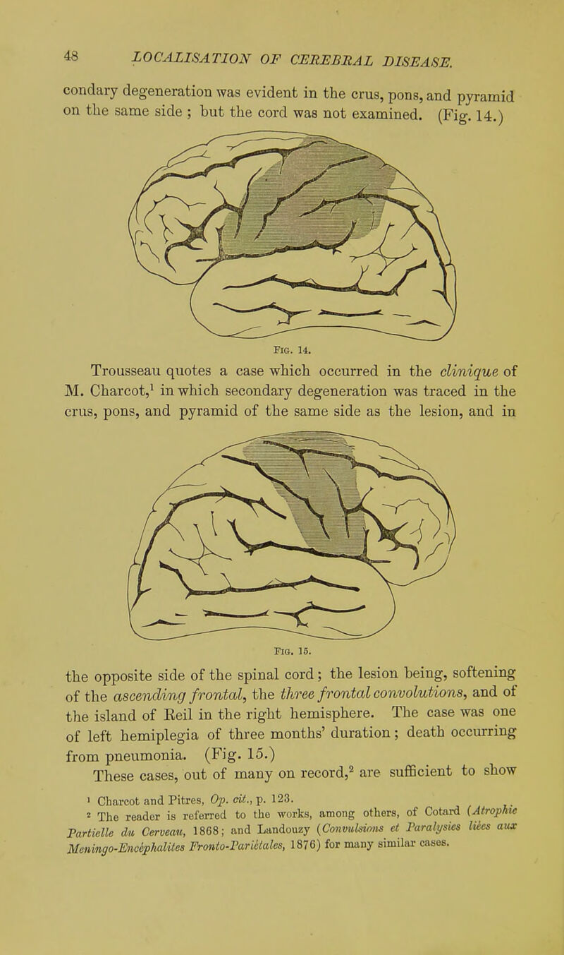 condary degeneration was evident in the crus, pons, and pyramid on the same side ; but the cord was not examined. (Fig. 14.) Fio. 14, Trousseau quotes a case which occurred in the clinique of M. Charcot,' in which secondary degeneration was traced in the crus, pons, and pyramid of the same side as the lesion, and in i. 15. the opposite side of the spinal cord; the lesion being, softening of the ascending frontal, the three frontal convolutions, and of the island of Keil in the right hemisphere. The case was one of left hemiplegia of three months' duration; death occurring from pneumonia. (Fig. 15.) These cases, out of many on record,^ are sufficient to show ' Charcot and Pitres, Op. cit., p. 123. 2 The reader is referred to the works, among others, of Cotard {AtropMc Partielle dti Cerveau, 1868; and Landouzy {Convukioiis et Paralysics lUes aux Meningo-Enoiphalites Fronto-FariUales, 1876) for many similar cases.