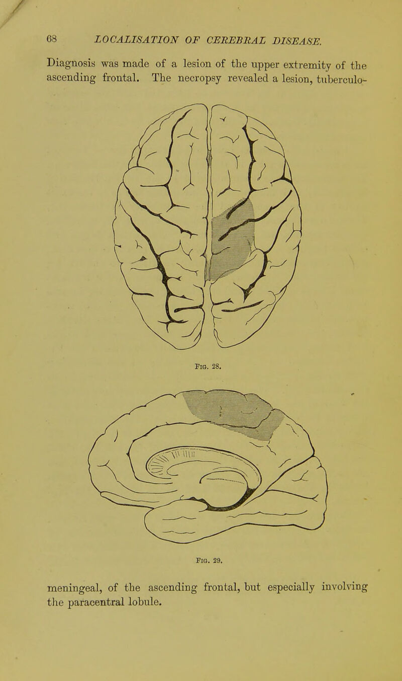 Diagnosis was made of a lesion of the upper extremity of the ascending frontal. The necropsy revealed a lesion, tnberculo- FlG. 29. meningeal, of the ascending frontal, but especially involving the paracentral lobule.