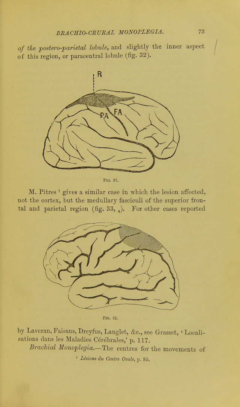 of the postero-parietal lobule, and slightly the inner aspect of this region, or paracentral lobule (fig. 32). ! R Fig. M. Pitres ' gives a similar case in which the lesion affected, not the cortex, but the medullary fasciculi of the superior fron- tal and parietal region (fig. 33, For other cases reported Fig. 32. by Laveran, Faisans, Dreyfus, Langlet, &c., see Grasset, ' Locali- sations dans les Maladies Cerebrales,' p. 117. Brachial Monoplegia.~The centres for the movements of ' Lisixms du Centre Ovale, p. 85.