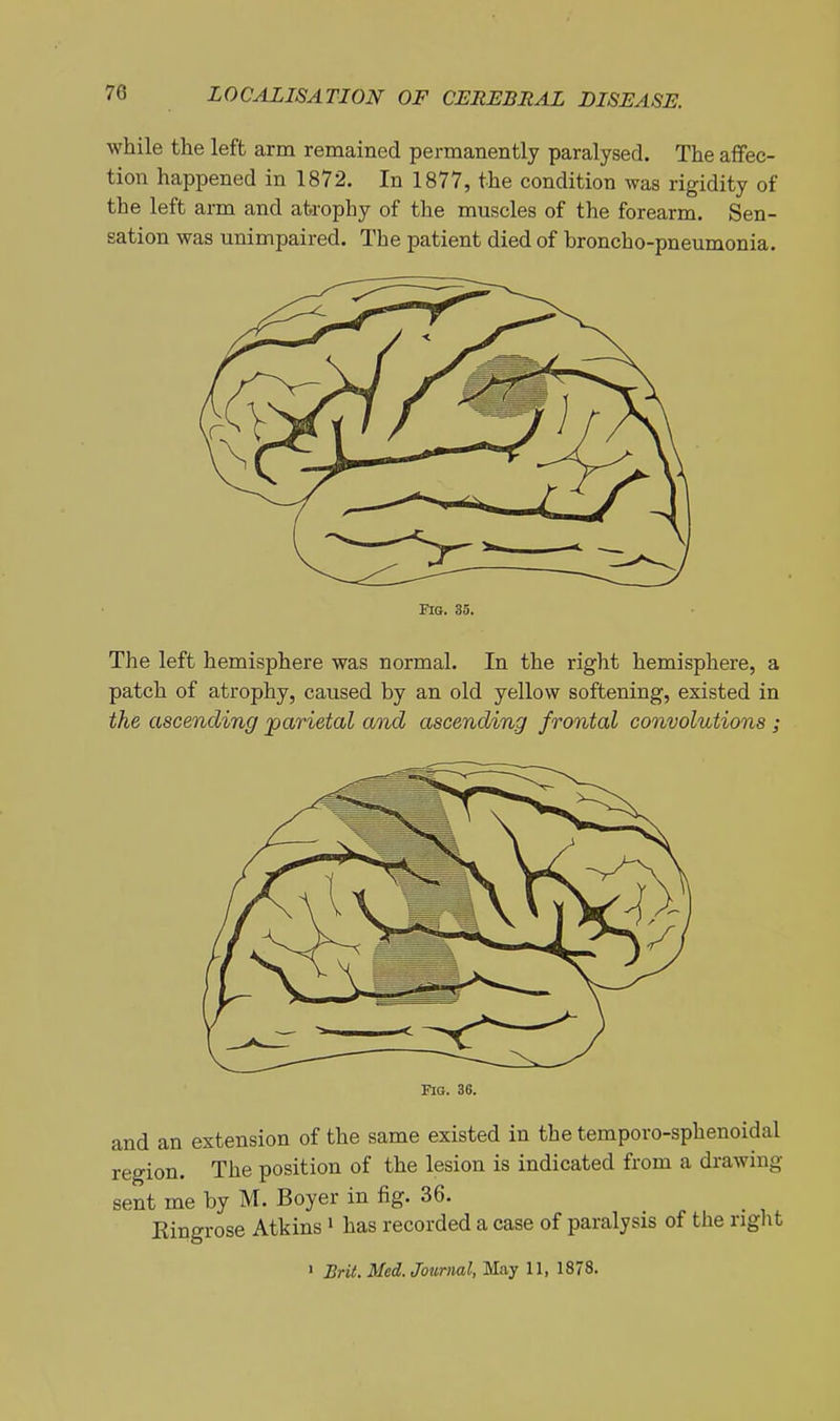 while the left arm remained permanently paralysed. The affec- tion happened in 1872. In 1877, the condition was rigidity of the left arm and atrophy of the muscles of the forearm. Sen- sation was unimpaired. The patient died of broncho-pneumonia. The left hemisphere was normal. In the right hemisphere, a patch of atrophy, caused by an old yellow softening, existed in the ascending parietal and ascending frontal convolutions ; sent me by M. Boyer in fig. 36. Eingrose Atkins i has recorded a case of paralysis of the right