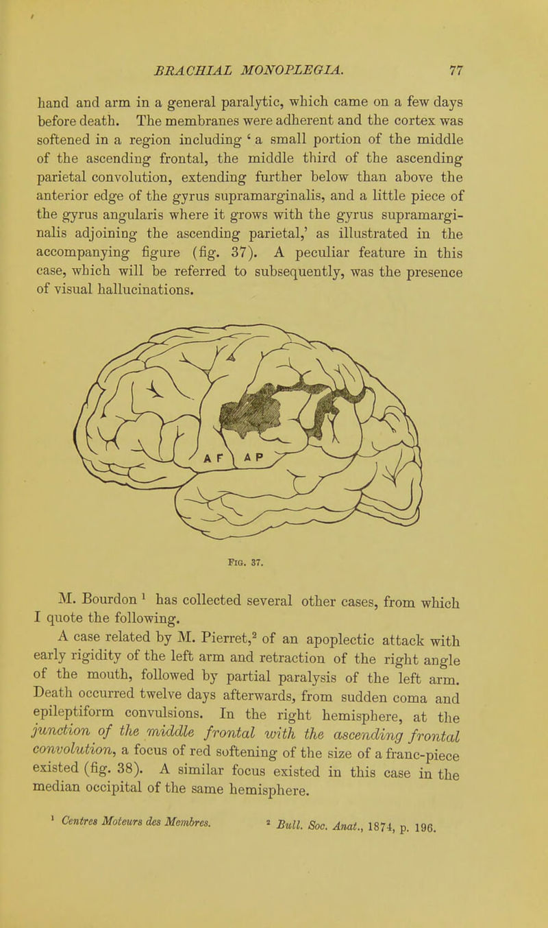 hand and arm in a general paralytic, which came on a few days before death. The membranes were adherent and the cortex was softened in a region including ' a small portion of the middle of the ascending frontal, the middle third of the ascending parietal convolution, extending further below than above the anterior edge of the gyrus supramarginalis, and a little piece of the gyrus angularis where it grows with the gyrus supramargi- nalis adjoining the ascending parietal,' as illustrated in the accompanying figure (fig. 37). A peculiar feature in this ease, which will be referred to subsequently, was the presence of visual hallucinations. Fig. 37. M. Bourdon > has collected several other cases, from which I quote the following. A case related by M. Pierret,^ of an apoplectic attack with early rigidity of the left arm and retraction of the right angle of the mouth, followed by partial paralysis of the left arm. Death occurred twelve days afterwards, from sudden coma and epileptiform convulsions. In the right hemisphere, at the junction of the middle frontal with the ascending frontal convolution, a focus of red softening of the size of a franc-piece existed (fig. 38). A similar focus existed in this case in the median occipital of the same hemisphere. ' Centres Moteurs des Mcmbrcs. 2 j^.^^ jg^^^ p_