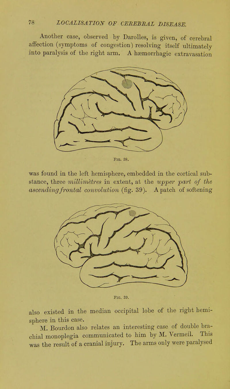 Another case, observed by Darolles, is given, of cerebral affection (symptoms of congestion) resolving itself ultimately into paralysis of the right arm. A hsemorrhagic extravasation FlO. 38. was found in the left hemisphere, embedded in the cortical sub- stance, three millimetres in extent, at the upper part of the ascending frontal convolution (fig. 39). A patch of softening Fig. 39. also existed in the median occipital lobe of the right hemi- sphere in this case. M. Bourdon also relates an interesting case of double bra- chial monoplegia communicated to him by M. Vermeil. This was the result of a cranial injury. The arms only were paralysed