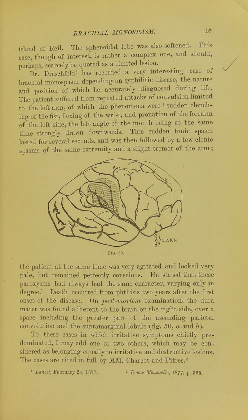 island of Reil. The sphenoidal lobe was also softened. This case, though of interest, is rather a complex one, and should, perhaps, scarcely be quoted as a limited lesion. Dr. DreschfekP has recorded a very interesting case of brachial monospasm depending on syphilitic disease, the nature and position of which he accurately diagnosed during life. The patient suffered from repeated attacks of convulsion limited to the left arm, of which the phenomena were ' sudden clench- ing of the fist, flexing of the wrist, and pronation of the forearm of''the left side, the left angle 6i the mouth being at the same time strongly drawn downwards. This sudden tonic spasm lasted for several seconds, and was then followed by a few clonic spasms of the same extremity and a slight tremor of the arm; the patient at the same time was very agitated and looked very pale, but remained perfectly conscious. He stated that these paroxysms had always had the same character, varying only in. degree.' Death occurred from phthisis two years after the first onset of the disease. On post-mortem examination, the dura mater was found adherent to the brain on the right side, over a space including the greater part of the ascending parietal convolution and the supramarginal lobule (fig. 50, a and b). To these cases in which irritative symptoms chiefly pre- dominated, I may add one or two others, which may be con- sidered as belonging equally to irritative and destructive lesions. The cases are cited in full by MM. Charcot and Pitres.^ ' Lancet, Febniary 2-i, 1877. = Eevuc Menswlle, 1877, p. 365. Fig. 50.