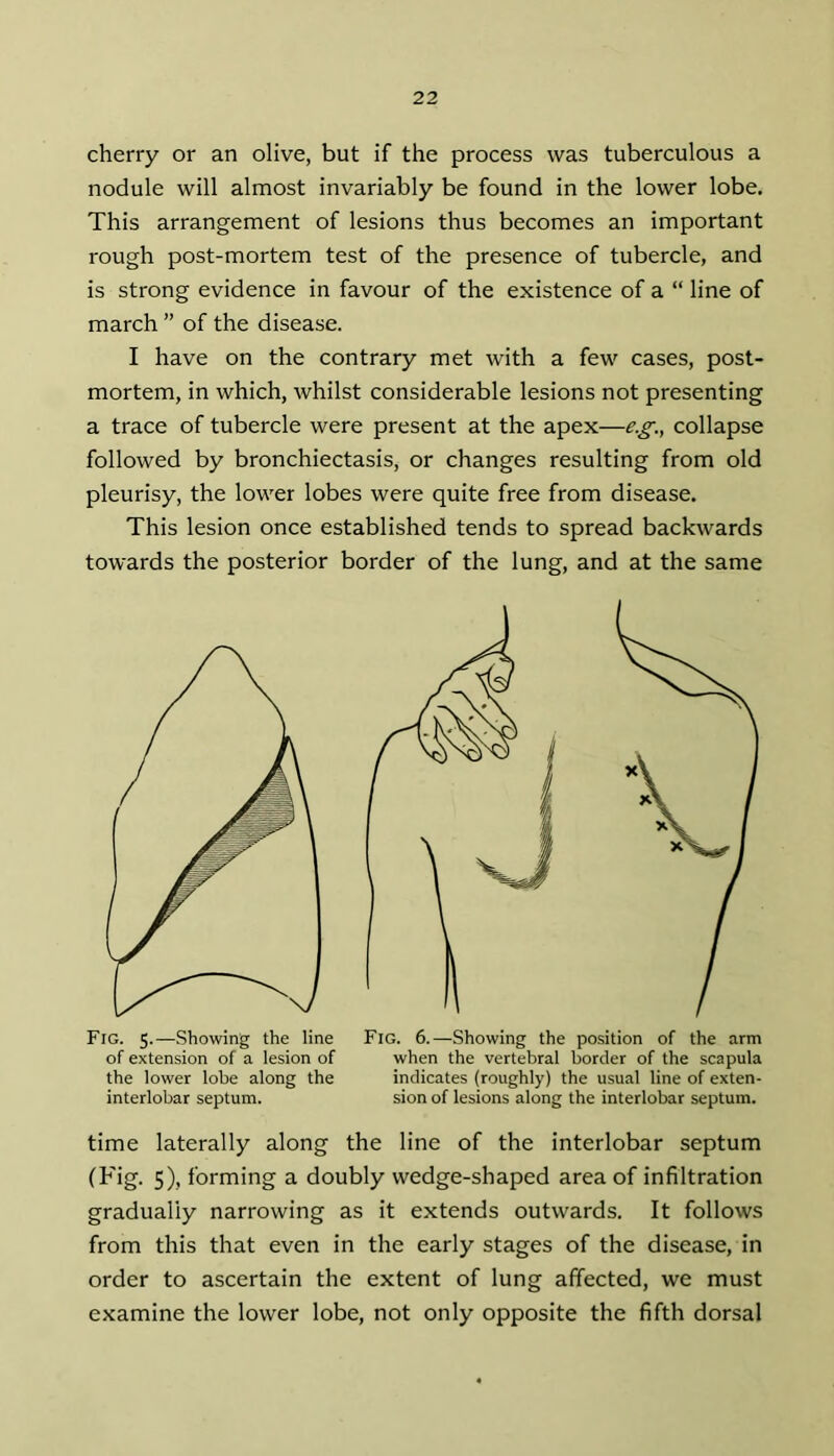 cherry or an olive, but if the process was tuberculous a nodule will almost invariably be found in the lower lobe. This arrangement of lesions thus becomes an important rough post-mortem test of the presence of tubercle, and is strong evidence in favour of the existence of a “ line of march ” of the disease. I have on the contrary met with a few cases, post- mortem, in which, whilst considerable lesions not presenting a trace of tubercle were present at the apex—e.g., collapse followed by bronchiectasis, or changes resulting from old pleurisy, the lower lobes were quite free from disease. This lesion once established tends to spread backwards towards the posterior border of the lung, and at the same Fig. 5.—Showing the line Fig. 6.—Showing the position of the arm time laterally along the line of the interlobar septum (Fig. 5), forming a doubly wedge-shaped area of infiltration gradually narrowing as it extends outwards. It follows from this that even in the early stages of the disease, in order to ascertain the extent of lung affected, we must examine the lower lobe, not only opposite the fifth dorsal of extension of a lesion of the lower lobe along the interlobar septum. when the vertebral border of the scapula indicates (roughly) the usual line of exten- sion of lesions along the interlobar septum.