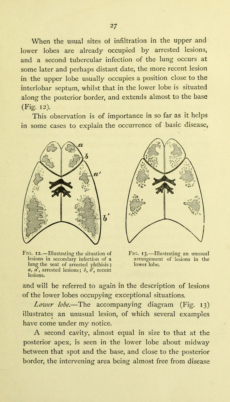 When the usual sites of infiltration in the upper and lower lobes are already occupied by arrested lesions, and a second tubercular infection of the lung occurs at some later and perhaps distant date, the more recent lesion in the upper lobe usually occupies a position close to the interlobar septum, whilst that in the lower lobe is situated along the posterior border, and extends almost to the base (Fig. 12). This observation is of importance in so far as it helps in some cases to explain the occurrence of basic disease, and will be referred to again in the description of lesions of the lower lobes occupying exceptional situations. Lower lobe.—The accompanying diagram (Fig. 13) illustrates an unusual lesion, of which several examples have come under my notice. A second cavity, almost equal in size to that at the posterior apex, is seen in the lower lobe about midway between that spot and the base, and close to the posterior border, the intervening area being almost free from disease Fig. 12.—Illustrating the situation of lesions in secondary infection of a lung the seat of arrested phthisis; a, o', arrested lesions; b, b', recent lesions. Fig. 13.—Illustrating an unusual arrangement of lesions in the lower lobe.