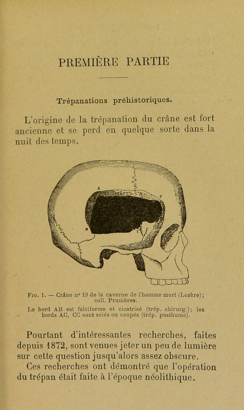 PREMIÈRE PARTIE Trépanations préhistoriques. L’origine de la trépanation du crâne est fort ancienne et se perd en quelque sorte dans la nuit des temps. Fig. 1. — Crâne n° 19 de la caverne do l'homme mort (Lozère); coll. Prunières. Lo bord AB est falciformo et cicatrisé (trép. chirurg.); les bords AC, CC sont sciés ou coupés (trép. posthume). Pourtant d’intéressantes recherches, faites depuis 1872, sont venues jeter un peu de lumière sur cette question jusqu’alors assez obscure. Ces recherches ont démontré que l’opération du trépan était faite à l’époque néolithique.