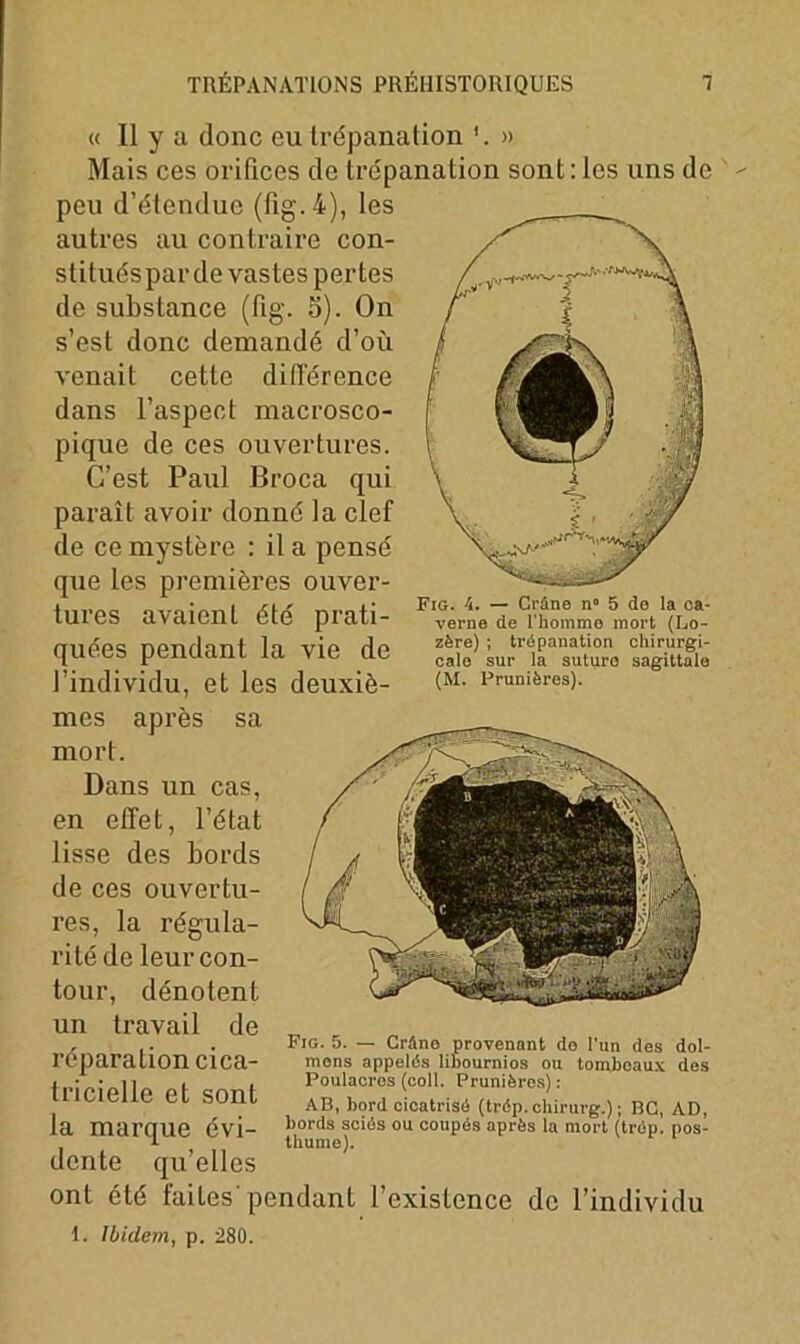 « 11 y a donc eu trépanation » Mais ces orifices de trépanation sont:les uns de peu d’étendue (fig. 4), les autres au contraire con- stitués par de vastes perles de substance (fig. S). On s’est donc demandé d’où venait cette différence dans l’aspect macrosco- pique de ces ouvertures. C’est Paul Broca qui paraît avoir donné la clef de ce mystère : il a pensé que les premières ouver- tures avaient été prati- quées pendant la vie de l’individu, et les deuxiè- mes après sa mort. Dans un cas, en effet, l’état lisse des bords de ces ouvertu- res, la régula- rité de leur con- tour, dénotent un travail de réparation cica- tricielle et sont la marque évi- dente qu’elles ont été faites'pendant l’existence de l’individu Fig. 4. — Crâne n» 5 do la ca- verne de l'homme mort (Lo- zère) ; trépanation chirurgi- cale sur la suture sagittale (M. Prunières). Fig. 5. — Crâne provenant de l'un des dol- mens appelés linournios ou tombeaux des Poulacres (coll. Prunières) : AB, bord cicatrisé (trép.chirurg.) ; BC, AD, bords sciés ou coupés après la mort (trép. pos- thume). 1. Ibidem, p. 280.