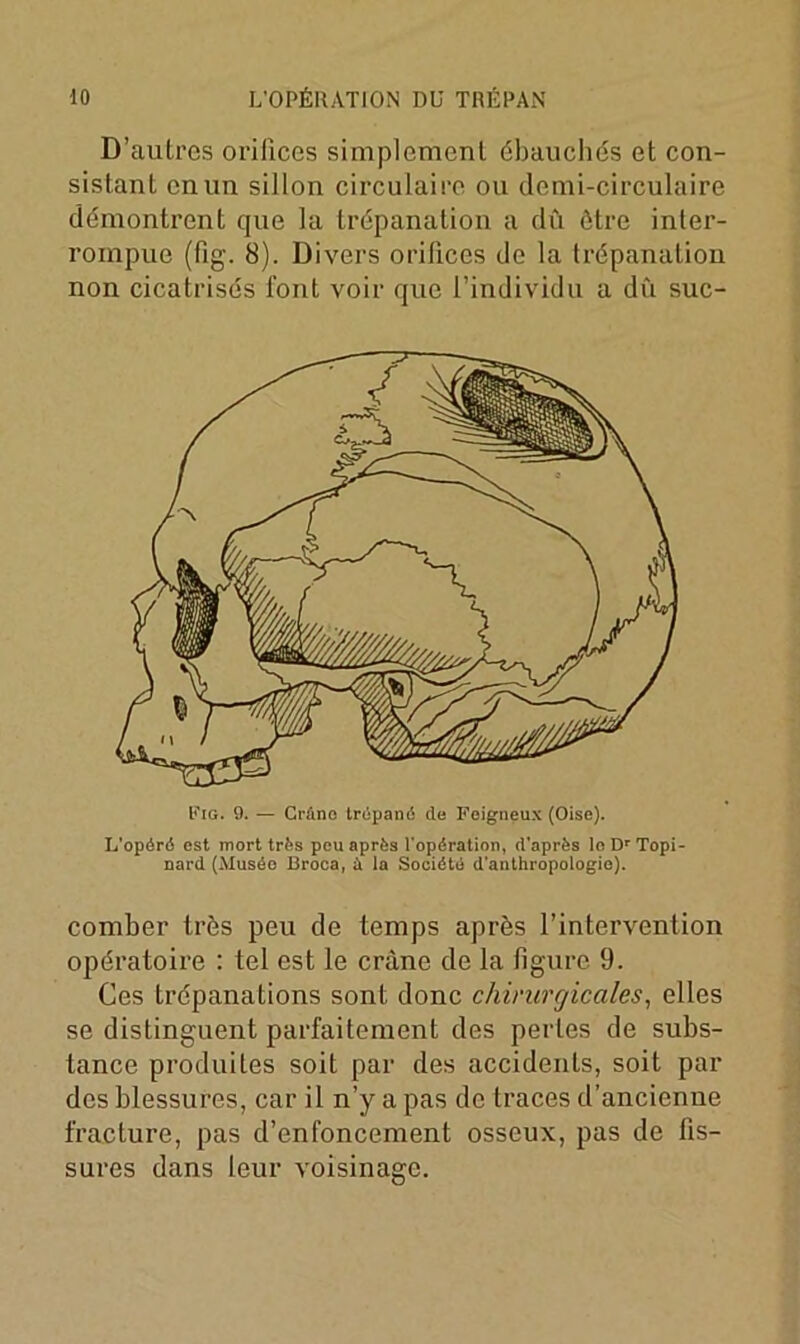 D’autres orifices simplement ébauchés et con- sistant en un sillon circulaire ou demi-circulaire démontrent que la trépanation a dû être inter- rompue (fig. 8). Divers orifices de la trépanation non cicatrisés font voir que l’individu a dû suc- Fig. 9. — Cràno trépané de Feigneux (Oise). L’opéré est mort très peu après l'opération, d'après le Dr Topi- nard (Muséo Broca, i la Société d'anthropologie). comber très peu de temps après l’intervention opératoire : tel est le crâne de la figure 9. Ces trépanations sont donc chirurgicales, elles se distinguent parfaitement des perles de subs- tance produites soit par des accidents, soit par des blessures, car il n’y a pas de traces d’ancienne fracture, pas d’enfoncement osseux, pas de fis- sures dans leur voisinage.