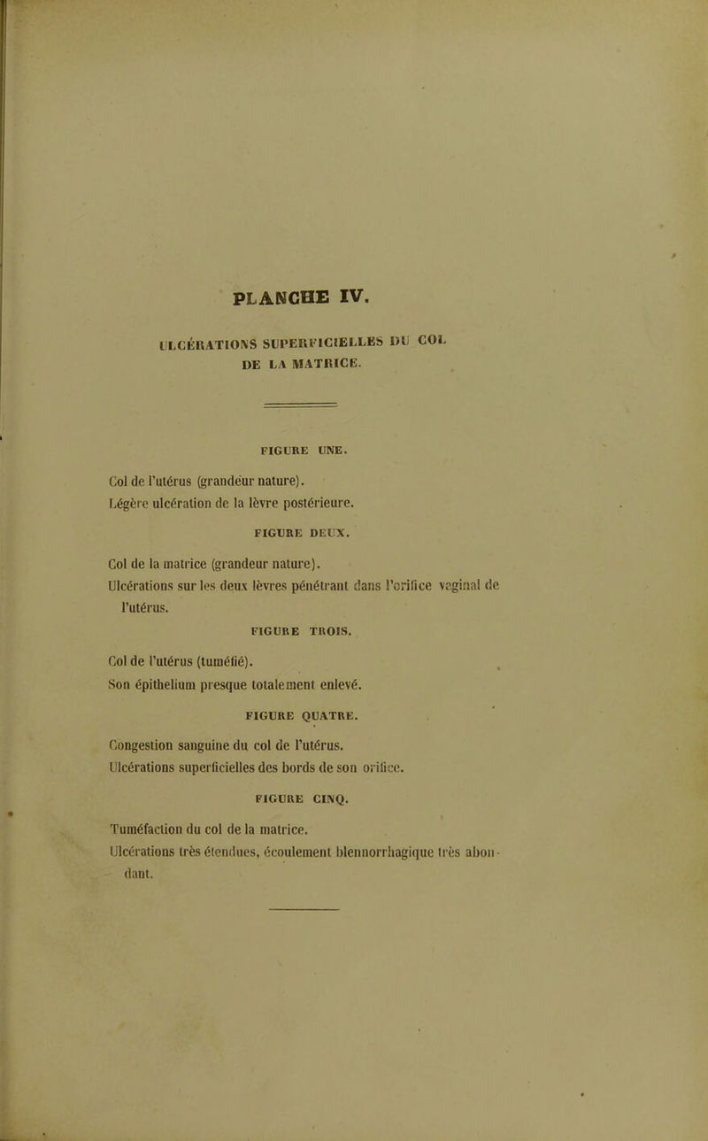 IJLCÉRATI0\S SLPERI' ICIELLBS DU COL DE LA MATRICE. FIGURE UNE. Col de l'utérus (grandeur nature). Légère ulcération de la lèvre postérieure. FIGURE DEUX. Col de la matrice (grandeur nature). Ulcérations sur les deux lèvres pénétrant dans l'orifice vaginal de l'utérus. FIGURE TROIS. Col de l'utérus (tuméfié). Son épithelium presque totalement enlevé. FIGURE QUATRE. Congestion sanguine du col de l'utérus. Ulcérations superficielles des bords de son orifice. FIGURE CINQ. Tuméfaction du col de la matrice. Ulcérations très étendues, écoulement blennorrhagique très abon- dant.