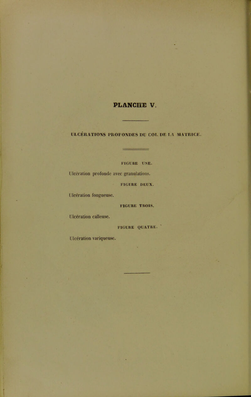 ULCÉIIATIOIVS PROFONDES DU COL DE LA iVIATKICE. FIGUaE UNE. Ulcéralion profonde avec granulations. FIGURE DEUX. Ulcération fongueuse. FIGURE TROIS. Ulcération calleuse. FIGURE QUATRE. Ulcération variqueuse.