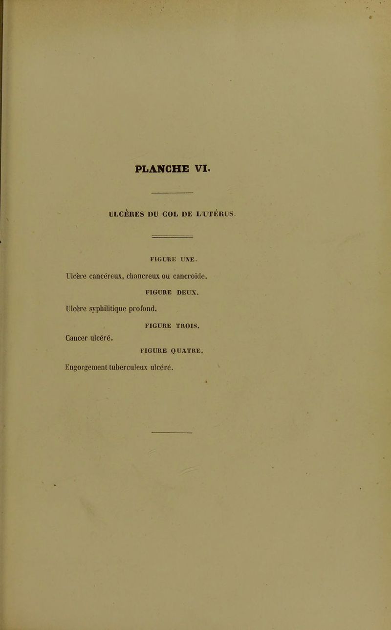 ULCÈRES DU COL DE L'UTÉllUS. FIGURE UNE. Ulcère cancéreux, chancreux ou cancroïde. FIGURE DEUX. Ulcère syphilitique profond. FIGURE TROIS. Cancer ulcéré. FIGURE QUATRE. Engorgement tuberculeux ulcéré.