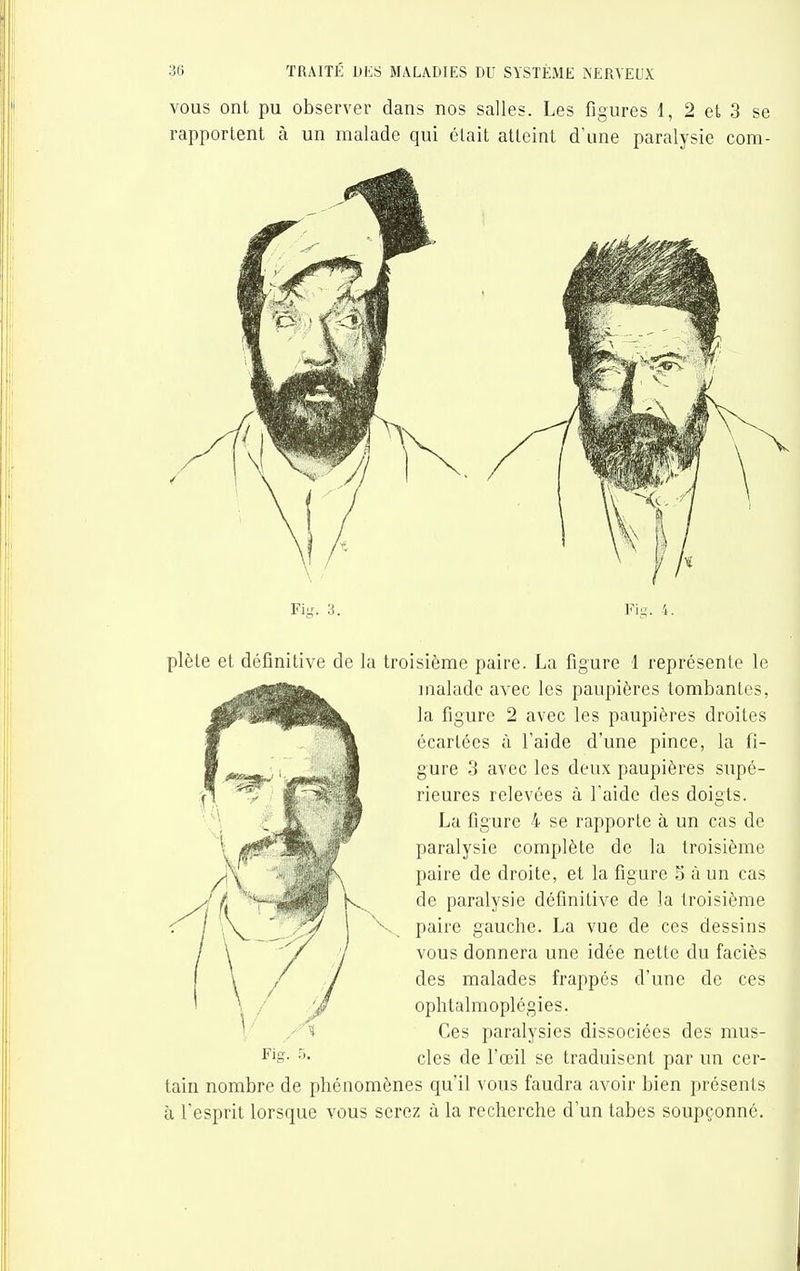 VOUS ont pu observer dans nos salles. Les figures 1, 2 et 3 se rapportent à un malade qui était atteint d'une paralysie com- Fi-. 3. Fi-. 4, plèle et définitive de la troisième paire. La figure 1 représente le malade avec les paupières tombantes, la figure 2 avec les paupières droites écartées à l'aide d'une pince, la fi- gure 3 avec les deux paupières supé- rieures relevées à l'aide des doigts. La figure 4 se rapporte à un cas de paralysie complète de la troisième paire de droite, et la figure S à un cas de paralysie définitive de la troisième paire gauche. La vue de ces dessins vous donnera une idée nette du faciès des malades frappés d'une de ces ophtalmoplégies. Ces paralysies dissociées des mus- cles de l'œil se traduisent par un cer- tain nombre de phénomènes qu'il vous faudra avoir bien présents à l'esprit lorsque vous serez à la recherche d'un tabès soupçonné.
