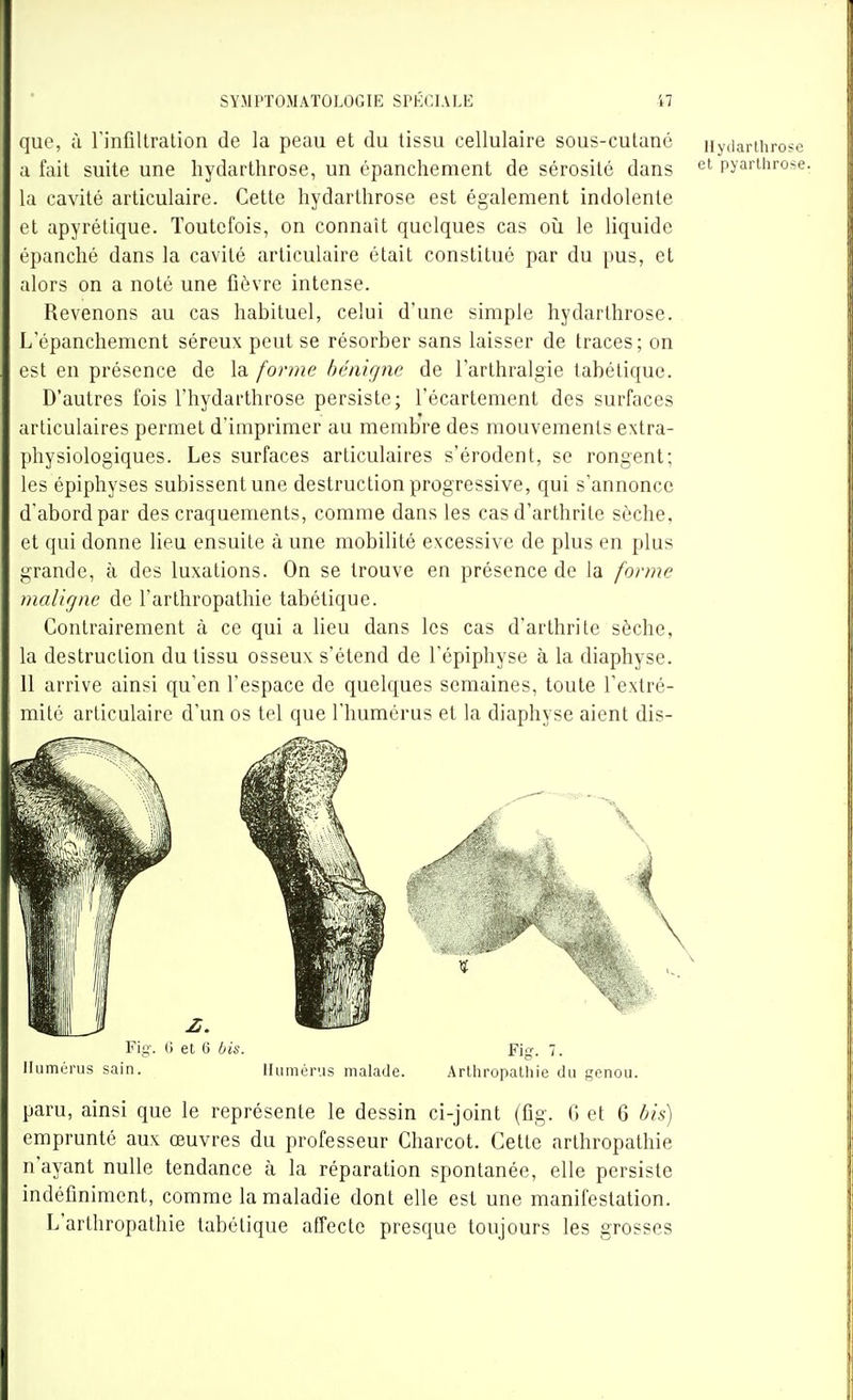que, ;\ rinfillration de la peau et du tissu cellulaire sous-cutané nydarihi ;i fait suite une hydarthrose, un épanchement de sérosité dans pyarth: la cavité articulaire. Cette hydarthrose est également indolente et apyrétique. Toutefois, on connaît quelques cas où le liquide épanché dans la cavité articulaire était constitué par du pus, et alors on a noté une fièvre intense. Revenons au cas habituel, celui d'une simple hydarthrose. L'épanchement séreux peut se résorber sans laisser de traces; on est en présence de la forme bénigne de l'arthralgie tabélique. D'autres fois l'hydarthrose persiste; l'écartement des surfaces articulaires permet d'imprimer au membre des mouvements extra- physiologiques. Les surfaces articulaires s'érodent, se rongent; les épiphyses subissent une destruction progressive, qui s'annonce d'abord par des craquements, comme dans les cas d'arthrite sèche, et qui donne lieu ensuite à une mobilité excessive de plus en plus grande, à des luxations. On se trouve en présence de la forme maligne de l'arthropathie tabétique. Contrairement à ce qui a lieu dans les cas d'arthrite sèche, la destruction du tissu osseux s'étend de l'épiphyse à la diaphyse. 11 arrive ainsi qu'en l'espace de quelques semaines, toute l'extré- mité articulaire d'un os tel que l'humérus et la diaphyse aient dis- llumérus sain. Humérus malade. Arlhropalhie du genou. paru, ainsi que le représente le dessin ci-joint (fig. G et 6 bis) emprunté aux œuvres du professeur Charcot. Cette arthropathie n'ayant nulle tendance à la réparation spontanée, elle persiste indéfiniment, comme la maladie dont elle est une manifestation. L'arthropathie tabétique atTecte presque toujours les grosses