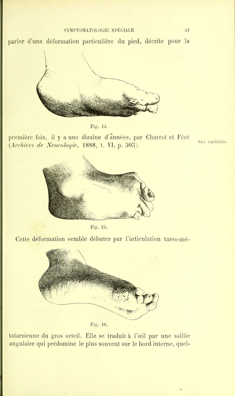parler d'une déformation particulière du pied, décrite pour la Fig. li. première fois, il y a une dizaine d'années, par Charcot et Féré {Archives de Newo/of/ie, 1888, t. VI, p. 30o). FijJT. 15. Cette déformation semble débuter par l'articulation tarso-mé- tatarsienne du gros orteil. Elle se traduit à l'œil par une saillie angulaire qui prédomine le plus souvent sur le bord interne, quel-