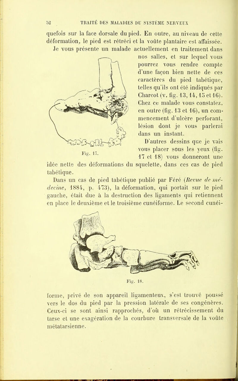 quefois sur la face dorsale du pied. En outre, au niveau de cette déformation^ le pied est rétréci et la voûte plantaire est affaissée. Je vous présente un malade actuellement en traitement dans nos salles, et sur lequel vous pourrez vous rendre compte d'une façon bien nette de ces caractères du pied tabétique, telles qu'ils ont été indiqués par Charcot {v. fig. 13,14,15 et 16). Chez ce malade vous constatez, en outre (fig. 13 et 16), un com- mencement d'ulcère perforant, lésion dont je vous parlerai dans un instant. D'autres dessins que je vais vous placer sous les yeux (fig. 17 et 18) vous donneront une idée nette des déformations du squelette, dans ces cas de pied tabétique. Dans un cas de pied tabétique publié par Féré {Revue de mé- decine, 1884, p. 473), la déformation, qui portait sur le pied gauche, était due à la destruction des ligaments qui retiennent en place le deuxième et le troisième cunéiforme. Le second cunéi- Fis. 17. Fig. 18. forme, privé de son appareil ligamenteux, s'est trouvé poussé vers le dos du pied par la pression latérale de ses congénères. Ceux-ci se sont ainsi rapprochés, d'oii un rétrécissement du tarse et une exagération de la courbure transversale de la voûte métatarsienne.
