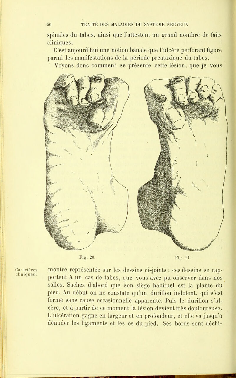 spinales du tabès, ainsi que l'attestent un grand nombre de faits cliniques. C'est aujourd'hui une notion banale que l'ulcère perforant figure parmi les manifestations de la période préataxique du tabès. Voyons donc comment se présente cette lésion, que je vous Fig. 20. ' Fi-. 21. montre représentée sur les dessins ci-joints ; ces dessins se rap- portent à un cas de tabès, que vous avez pu observer dans nos salles. Sachez d'abord que son siège habituel est la plante du pied. Au début on ne constate qu'un durillon indolent, qui s'est formé sans cause occasionnelle apparente. Puis le durillon s'ul- cère, et à partir de ce moment la lésion devient très douloureuse. L'ulcération gagne en largeur et en profondeur, et elle va jusqu'à dénuder les ligaments et les os du pied. Ses bords sont déchi- Caractères cliniques.