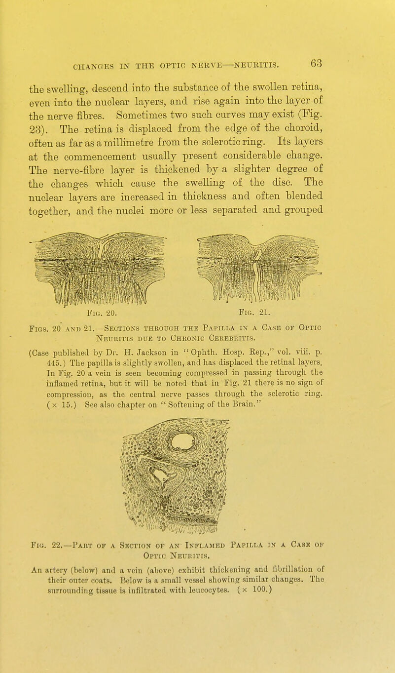 the swelling, descend into the substance of the swollen retina, even into the nnclear layers, and rise again into the layer of the nerve fibres. Sometimes two such curves may exist (Fig. 23). The retina is displaced from the edge of the choroid, often as far as a millimetre from the sclerotic ring. Its layers at the commencement usually present considerable change. The nerve-fibre layer is thickened by a slighter degree of the changes which cause the swelling of the disc. The nuclear layers are increased in thickness and often blended together, and the nuclei more or less separated and grouped i'Ki. 20. Fig. 21. Figs. 20 and 21.—Sections through the Papilla in a Case of Optic NEUIilTIS DUE TO ChRONIC CeREBUITIS. (Case piiblisheil by Dr. H. Jackson in  Oplith. Hosp. Rep., vol. viii. p. 445.) The papilla is slightly swollen, and has displaced the retinal layers. In Fig. 20 a vein is seen becoming compressed in passing through the inflamed retina, but it will be noted that in Fig. 21 there is no sign of compression, as the central nerve passes through the sclerotic ring. ( X 15.) See also chapter on  Softening of the Brain. Fig. 22.—Part of a Section of an' Inflamed Papilla in a Case of Optic Neuritis, An artery (below) and a vein (above) exhibit thickening and fibrillation of their outer coats. PjbIow is a small vessel showing similar changes. The surrounding tissue is infiltrated with leucocytes, (x 100.)