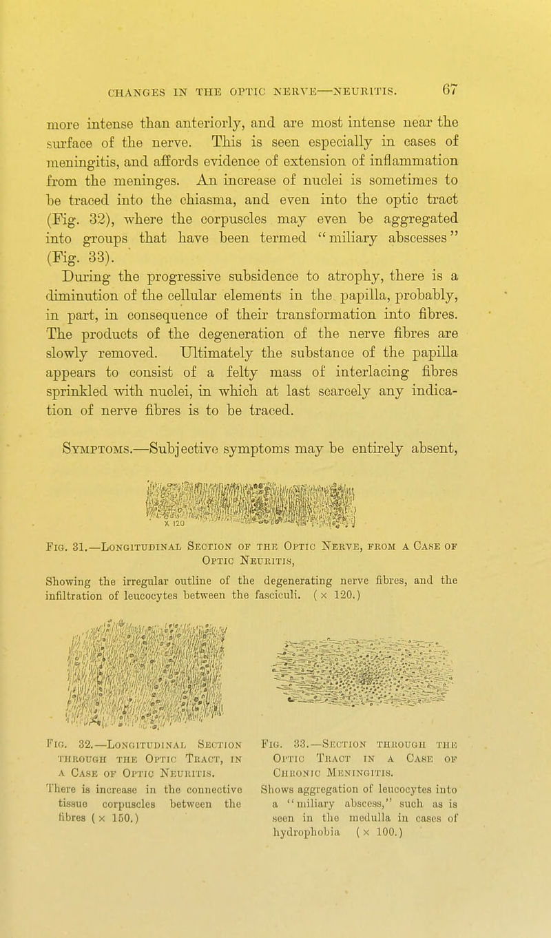 more intense than anteriorly, and are most intense near the stu'face of the nerve. This is seen especially in cases of meningitis, and affords evidence of extension of inflammation fi'om the meninges. An increase of nuclei is sometimes to be traced into the chiasma, and even into the optic tract (Fig. 32), where the corpuscles may even be aggregated into groups that have been termed miliary abscesses (Fig. 33). ■ During the progressive subsidence to atrophy, there is a diminution of the cellular elements in the papilla, probably, in part, in consequence of their transformation into fibres. The products of the degeneration of the nerve fibres are slowly removed. Ultimately the substance of the papilla appears to consist of a felty mass of interlacing fibres sprinkled with nuclei, iu which at last scarcely any indica- tion of nerve fibres is to be traced. Symptoms.—Subjective symptoms may be entirely absent, Fig. 31.—Longitudinal Section of the Optic Neeve, from a Case of Optic Neuritis, Showing the irregular outline of the degenerating nerve fibres, and the infiltration of leucocytes between the fasciculi, (x 120.) Fig. 32.—Longitudinal Section iHKOUGH the Optic Tract, in a Ca.se of Optic Neuritis. There is increase in the connective tissue corpuscles between tlie Kbres ( x 150.) Fig. 33.—Section thkougu tiik Optic Tract in a Case of Chisonic Meningitis. Shows aggregation of leucocytes into a miliary abscess, such as is seen in the medulla in cases of hydrophobia (x 100.)