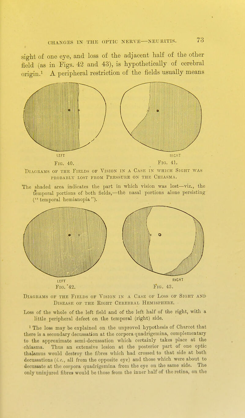 sight of one eye, and loss of the adjacent half of the other field (as in Figs. 42 and 43), is hypothetically of cerehral m-igin.i peripheral restriction of the fields usually means left right Fig. 40. Fig. 41. Diagrams of the Fields of Vision in a Case in which Sight avas PROBABLY lost FROM PeESSUUE ON THK ChIASMA. The shaded area indicates the part in which vision was lost—viz., the temporal portions of both iields,—the nasal portions alone persisting (temporal hemianopia). Fig. 42. Fig. 43. Diagrams of the Fields of Vision in a Case of Loss of Sight and Disease of the Right Cerebral Hemisphehe. ■ Loss of the whole of the left field and of the left half of the right, with a little peripheral defect on the temporal (right) side. ^ The lose may be explained on the unproved hypothesis of Charcot that there is a secondary decussation at the corpora quadrigemina, complementary to the approximate semi-decussation which certainly takes place at the chiasma. Thus an extensive lesion at the posterior part of one optic thalamus would destroy the iibres which had crossed to that side at both decussations {i.e., all from the opposite eye) and those which were about to decussate at the corpora quadrigemina from the eye on the same side. The only uninjured fibres would be those from the inner half of the retina, on the