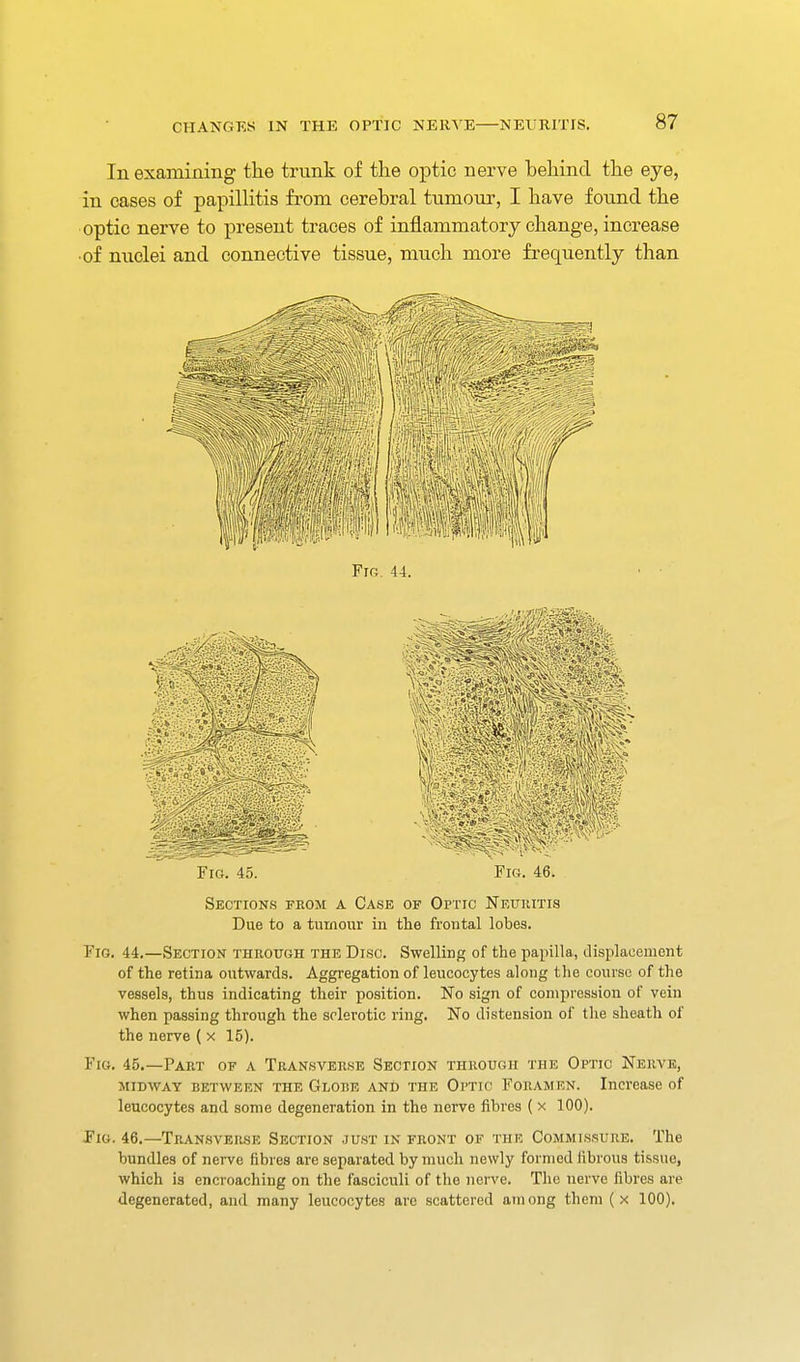 In examining the trunk of tlie optic nerve behind the eye, in cases of papillitis from cerebral tumour, I have found the optic nerve to present traces of inflammatory change, increase ■of nuclei and connective tissue, much more frequently than Fig. 45. Fig. 46. Sections from a Case of Optic Neuiiiti8 Due to a tumour in the frontal lobes. Fig. 44.—Section through the Disc. Swelling of the papilla, displacement of the retina outwards. Aggregation of leucocytes along the course of the vessels, thus indicating their position. No sign of compression of vein when passing through the sclerotic ring. No distension of the sheath of the nerve ( x 15). Fig. 45.—Part of a Transverse Section through the Optic Nerve, MIDWAY between THE Glode AND THE Oi'Tic FoRAMEN. Increase of leucocytes and some degeneration in the nerve iibres { x 100). Jig. 46.—Transverse Section just in front of the Commissure. The bundles of nerve fibres are separated by much newly formed librous tissue, which is encroaching on the fasciculi of the nerve. The nerve fibres are degenerated, and many leucocytes are scattered among them (x 100).