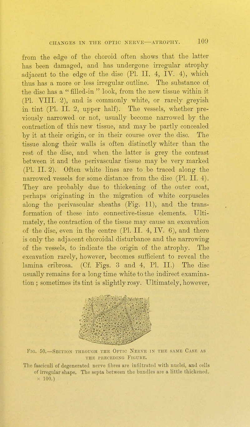 from ttie edge of the choroid often shows that the latter has been damaged, and has undergone irregular atrophy adjacent to the edge of the disc (PI. II, 4, lY. 4), which thus has a more or less irregular outline. The substance of the disc has a  filled-in  look, from the new tissue within it (PI. YIII. 2), and is commonly white, or rarely greyish in tint (PI. II. 2, upper half). The vessels, whether pre- viously narrowed or not, usually become narrowed by the contraction of this new tissue, and may be partly concealed by it at their origin, or in their course over the disc. The tissue along their walls is often distinctly whiter than the rest of the disc, and when the latter is grey the contrast between it and the perivascular tissue may be very marked (PI. II. 2). Often white lines are to be traced along the narrowed vessels for some distance from the disc (PI. II. 4). They are probably due to thickening of the outer coat, perhaps originating in the migration of white corpuscles along the perivascular sheaths (Fig. 11), and the trans- formation of these into connective-tissue elements. Ulti- mately, the contraction of the tissue may cause an excavalion of the disc, even in the centre (PL II. 4, lY. 6), and there is only the adjacent choroidal disturbance and the narrowing of the vessels, to indicate the origin of the atrophy. The excavation rarely, however, becomes sufficient to reveal the lamina cribrosa. (Of. Pigs. 3 and 4, PI. II.) The disc usually remains for a long time white to the indirect examina- tion ; sometimes its tint is slightly rosy. Ultimately, however, 4 -i^l^^^^^^'i^^f^'^i Fio. 50.—Section through the Optic Nejive in the same Case as THE preceding FiGURE. The fasciculi of degenerated nerve fibres are infiltnited with nuclei, and cells of irregular shape. Tlie septa between the bundles are a little thickened. X 100.)