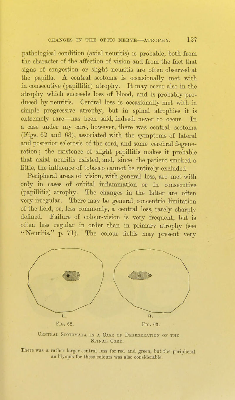 pathological condition (axial neuritis) is probable, both from the character of the affection of vision and from the fact that signs of congestion or slight neuritis are often observed at the papilla. A central scotoma is occasionally met with in consecutive (papillitic) atrophy. It may occur also in the atrophy which succeeds loss of blood, and is probably pro- duced by neuritis. Central loss is occasionally met with in simple progressive atrophy, but in spinal atrophies it is extremely rare—has been said, indeed, never to occur. In a case under my care, however, there was central scotoma (Figs. 62 and 63), associated with the symptoms of lateral and posterior sclerosis of the cord, and some cerebral degene- ration; the existence of sHght papillitis makes it probable that axial neuritis existed, and, since the patient smoked a little, the influence of tobacco cannot be entirely excluded. Peripheral areas of vision, with general loss, are met with only in cases of orbital inflammation or in consecutive (papillitic) atrophy. The changes in the latter are often very irregular. There may be general, concentric limitation of the field, or, less commonly, a central loss, rarely sharply defined. Failure of colour-vision is very frequent, but is often less regular in order than in primary atrophy (see Neuritis, p. 71). The colour fields may present very L R. I'lo. 62. Fio. 63. Centkal Scotomata in a Case of Degbnekation of the Spinal Cord. There was a rather larger central loss for red and green, but the peripheral amblyopia for these colours was also considerable.