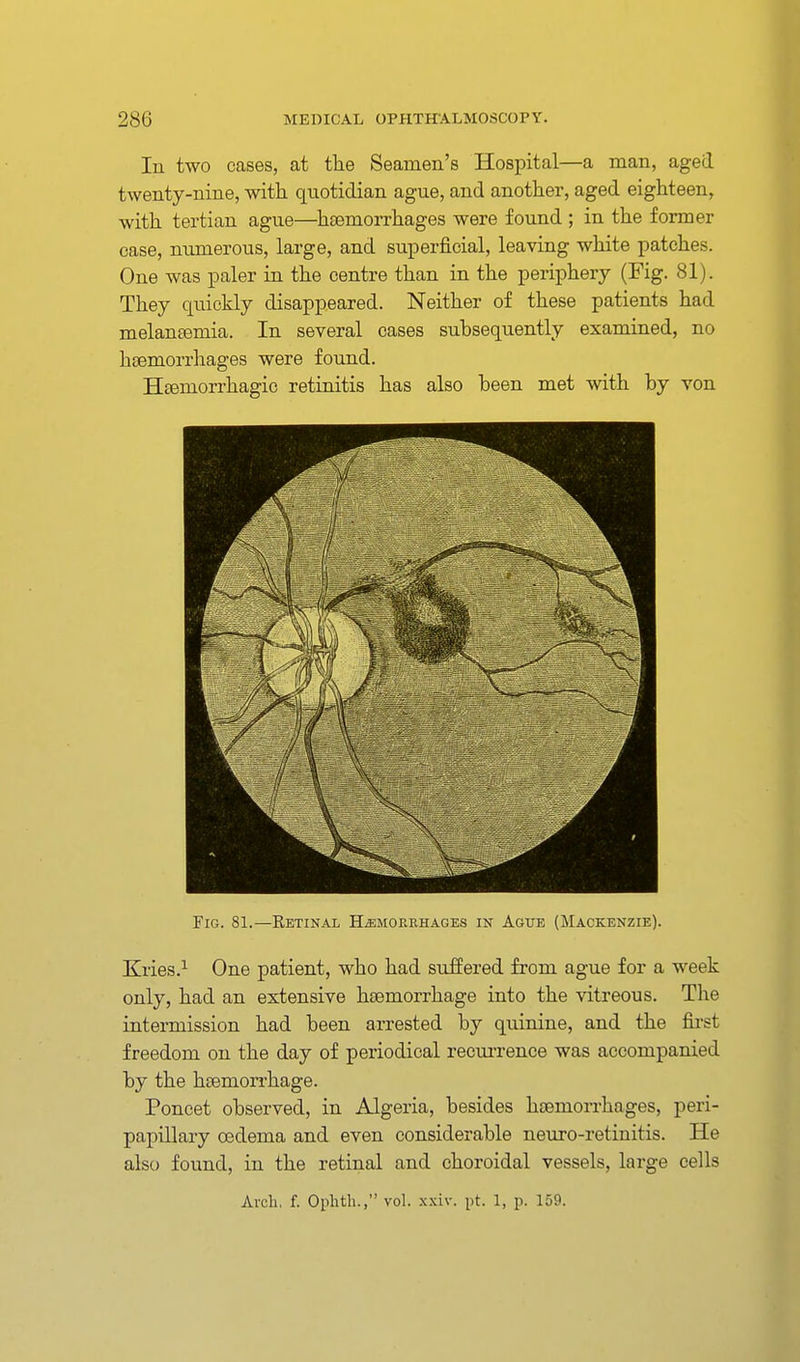 In two cases, at the Seamen's Hospital—a man, aged twenty-nine, with quotidian ague, and another, aged eighteen, with tertian ague—haemorrhages were found ; in the former case, numerous, large, and superficial, leaving white patches. One was paler in the centre than in the periphery (Fig. 81). They quickly disappeared. Neither of these patients had melaneemia. In several oases subsequently examined, no hjEmorrliages were found. HEsmorrhagic retinitis has also been met with by von Fig. 81.—Retinal Hemorrhages in Ague (Mackenzie). Kries.^ One patient, who had sufPered from ague for a week only, had an extensive haemorrhage into the vitreous. The intermission had been arrested by quinine, and the first freedom on the day of periodical recm-rence was accompanied by the haemon-hage. Poncet observed, in Algeria, besides haemorrhages, peri- papillary oedema and even considerable neuro-retinitis. He also found, in the retinal and choroidal vessels, large cells Arch, f. Ophtli., vol. .\xiv. pt. 1, p. 159.