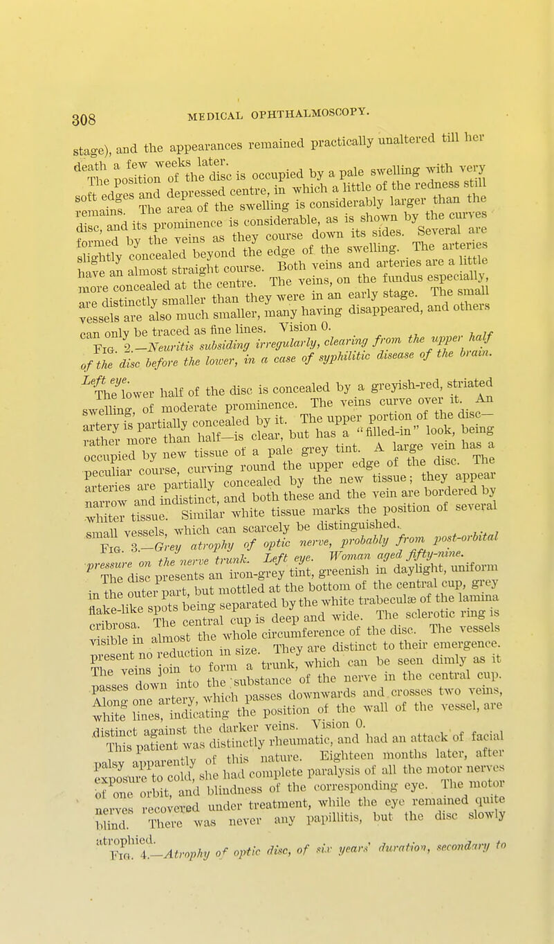 ste^e), mi the appearances remained practically nnaltered till her 'SrpoSoromfdiscis oeenpicd hy a pale swelling very have an ^^^^^^t 'X The veins, on the fimdus especially, more concealed at the centie. int vi^ms, u x Te distinctly smaller than they ^vere m an early stage^ ^^^'^'^^^ vessels are also much smaller, many having disappeared, and otheis can only be traced as fine lines. Vision 0. o/J.! &c a« lower, in a case of sypMhUo d^sease of the b,ain. are pitially Concealed by the new tissue; tliey appear nanw and indistinct, and both these and the vem are bordered by vMteT tissue. Similar white tissue marks the position of several small vessels, which can scarcely be distmguished.^ F a 3 -(? «2/ atrop^'y of optic nerve, prolaMy fron^ postM \r, thP nerve trunk. Left eye. Wmnan aged jifty-nine. Zdi :p? se^t a^^^^^^^^ tiL, greenish in daylight, uniM™ ine aisc pit=» ...^.tled at the bottom of the central cup, gi'ey ?riit:;rbeirp-^^^^^ -hite trabecule of the lamma H ; n The Srnl cup is deep and wide. The sclerotic rmg is ™t nol^duction m size. They are distinct to their emergence The veins oin to form a trunk, which can be seen dimly as it ^^Z^To^Tir^^o the substance of the nerve in the central cup. passes Qowii n _ downwards and crosses two vems, sh^ ir ^ TZ^^ of C orbit and blindness of the corresponding eye. The motor ' nerves recovered under treatment, while the eye remained qui e Zd rhev^e was never any papillitis, but the disc slowly '^'^trt-Atrophy 0.^ optk disc, of sir years' duration, secondary to