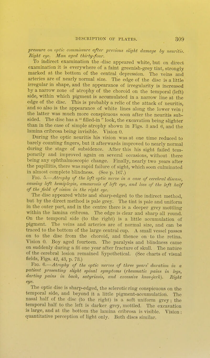 pressure on optic commissure after previous slight damage by neuritis. Right eye. Man aged thirty-four. To indii-ect examination the -disc appeared white, but on direct examination it is everywhere of a faint greenish-grey tint, strongly marked at the bottom of the central depression. The veins and arteries are of nearly normal size. The edge of the disc is a little irregular in shape, and the appearance of irregularity is increased by a narrow zone of atrophy of the choroid on the temporal (left) side, within Avhich pigment is accmnulated in a narrow line at the edge of the disc. This is probably a relic of the attack of neuritis, and so also is the appearance of wliite lines along the lower vein ; the latter was much more conspicuous soon after the neuritis sub- sided. The disc has a  filled-in  look, the excavation being shghter than in the case of simple atrophy shown in Figs. 3 and 6, and the lamina cribrosa being invisible. Vision 0. Durmg the optic nem-itis his vision was at one time reduced to barely coimting fingers, but it afterwards improved to nearly normal during the stage of subsidence. After this his sight failed tem- porarily and improved again on several occasions, >vithout there being any ophthalmoscopic change. Finally, nearly tAVO years after the papillitis, there was rapid failure of sight, which soon culminated in almost complete blindness. (See p. 1U7.) Fig. 5.—Atrophy of the left optic nerve in a case of cerebral disease, causing left hemiplegia, amaurosis of left eye, and loss of the left half of the field of vision in the right eye. The disc appeared white and sharp-edged to the indirect method, but by the direct method is pale grey. The tint is pale and uniform in the outer part, and in the centre there is a deeper grey mottling within the lamina cribrosa. The edge is clear and sharp all round. On the temporal side (to the right) is a little accumulation of pigment. The veins and arteries are of normal size, and can be traced to the bottom of the large central cup. A small vessel passes on to the disc from the choroid, and thence on to the retina. Vision 0. Boy aged fourteen. The paralysis and blindness came on suddenly during a fit one year after fracture of skull. The nature of the cerebral lesion remained hypothetical. (See charts of visual fields. Figs. 42, 4.3, p. 73.) Fig. 6.—Atrophy of the optic nerves of three years' duration in a patient presenting slight spi7ial symptoms {rheumatic pains hi legs, darting pains in back, satyriasis, and excessive knee-jerk). Right eye. The optic disc is sharp-edged, the sclerotic ring conspicuous on the temporal side, and beyond it a little pigment-accumulation. The nasal half of the disc (to the right) is a soft uniform grey; the temporal half to the left is darker grey, mottled. The excavation is large, and at the bottom the lamina cribrosa is visible. Vision: quantitative perception of light only. Both discs similar.