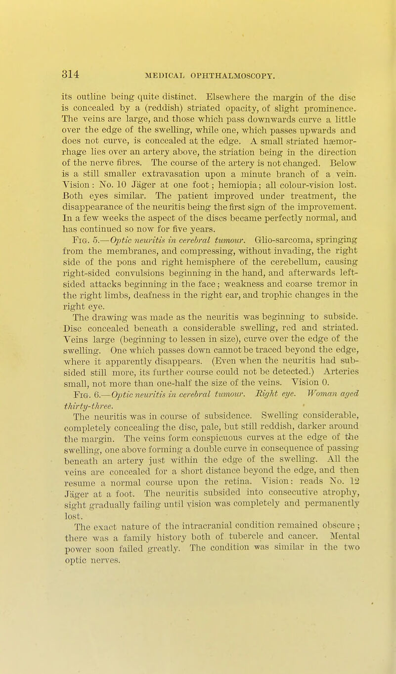 its outline being quite distinct. Elsewhere the margin of the disc is concealed by a (reddish) striated opacity, of slight prominence. The veins are large, and those which pass downwards curve a little over the edge of the swelling, while one, which passes upwards and does not curve, is concealed at the edge. A small striated hasmor- rhage lies over an artery above, the striation being in the dii-ection of the nerve fibres. The course of the artery is not changed. Below is a still smaller extravasation upon a minute branch of a A'ein. Vision: No. 10 Jiiger a,t one foot; hemiopia; all colour-vision lost. Both eyes similar. The patient improved under treatment, the disappearance of the nem'itis being the first sign of the improvement. In a few weeks the aspect of the discs became perfectly normal, and has continued so now for five years. Fig. 5.—Optic neuritis in cerebral tumour. Glio-sarcoma, springing from the membranes, and compressing, without invading, the right side of the pons and right hemisphere of the cerebellum, causing right-sided convulsions beginning in the hand, and afterwards left- sided attacks beginning in the face; wealcness and coarse tremor in the right limbs, deafness in the right ear, and trophic changes in the right eye. The drawing was made as the nem'itis was beginning to subside. Disc concealed beneath a considerable swelling, red and striated. Veins large (beginning to lessen in size), cmwe over the edge of the swelling. One which passes down cannot be traced beyond the edge, where it apparently disappears. (Even when the nem-itis had sub- sided still more, its further course could not be detected.) Ai'teries small, not more than one-half the size of the veins. Vision 0. Fig. 6.— Otitic neuritis in cerebral tumour. 'Right eye. Wo7na7i aged thirty-three. The neuritis was in course of subsidence. Swelling considerable, completely concealing the disc, pale, but still reddish, darker around the margin. The veins form conspicuous curves at the edge of tlie swelling, one above forming a double cm-ve in consequence of passing beneath an artery just within the edge of the swelling. All the veins are concealed for a short distance beyond the edge, and then resume a normal com-se upon the retina. Vision: reads No. 12 Jiiger at a foot. The neuritis subsided mto consecutive atrophy, sight gradually failing until vision was completely and permanently lost. The exact nature of the intracranial condition remained obscure ; there was a family history both of tubercle and cancer. Mental power soon failed greatly. The condition was similar in the two optic nerves.