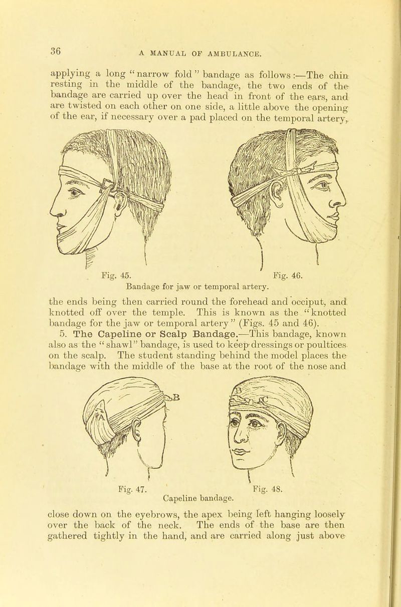applying a long  narrow fold  bandage as follows :—The chin resting in the middle of the bandage, the two ends of the bandage are carried up over the head in front of the ears, and are twisted on each other on one side, a little above the opening of the ear, if necessary over a pad placed on the temporal artery, Bandage for jaw or temporal artery the ends being then carried round the forehead and occiput, and knotted off over the temple. This is known as the knotted bandage for the jaw or temporal artery  (Figs. 45 and 46). 5. The Capeline or Scalp Bandage.—This bandage, known also as the  shawl bandage, is used to keep dressings or poultices on the scalp. The student standing behind the model places the bandage with the middle of the base at the root of the nose and Fig. 47. Fig. 48. Capeline bandage. close down on the eyebrows, the apex being left hanging loosely over the back of the neck. The ends of the base are then gathered tightly in the hand, and are carried along just above