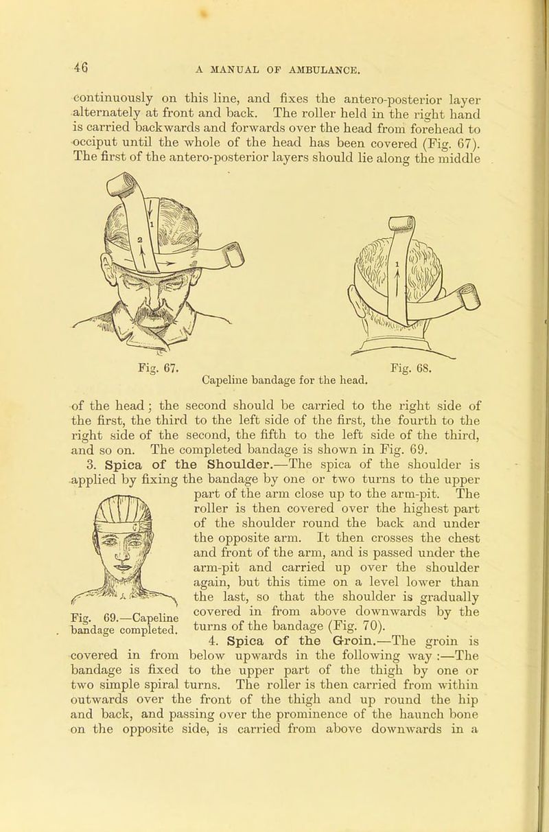 continuously on this line, and fixes the antero-posterior layer- alternately at front and back. The roller held in the right hand is carried backwards and forwards over the head from forehead to occiput until the whole of the head has been covered (Fig. 67). The first of the antero-posterior layers should lie along the middle Fig. 67. Capeline bandage for the head. Fig. 68. of the head; the second should be carried to the right side of the first, the third to the left side of the first, the fourth to the right side of the second, the fifth to the left side of the third, and so on. The completed bandage is shown in Pig. 69. 3. Spica of the Shoulder.—The spica of the shoulder is applied by fixing the bandage by one or two turns to the upper part of the arm close up to the arm-pit. The roller is then covered over the highest part of the shoulder round the back and under the opposite arm. It then crosses the chest and front of the arm, and is passed under the arm-pit and carried up over the shoulder again, but this time on a level lower than the last, so that the shoulder is gradually covered in from above downwards by the turns of the bandage (Fig. 70). 4. Spica of the Groin.—The groin is below upwards in the following way :—The to the upper part of the thigh by one or two simple spiral turns. The roller is then carried from within outwards over the front of the thigh and up round the hip and back, and passing over the prominence of the haunch bone on the opposite side, is carried from above downwards in a Fig. 69.—Capeline bandage completed. covered in from bandage is fixed