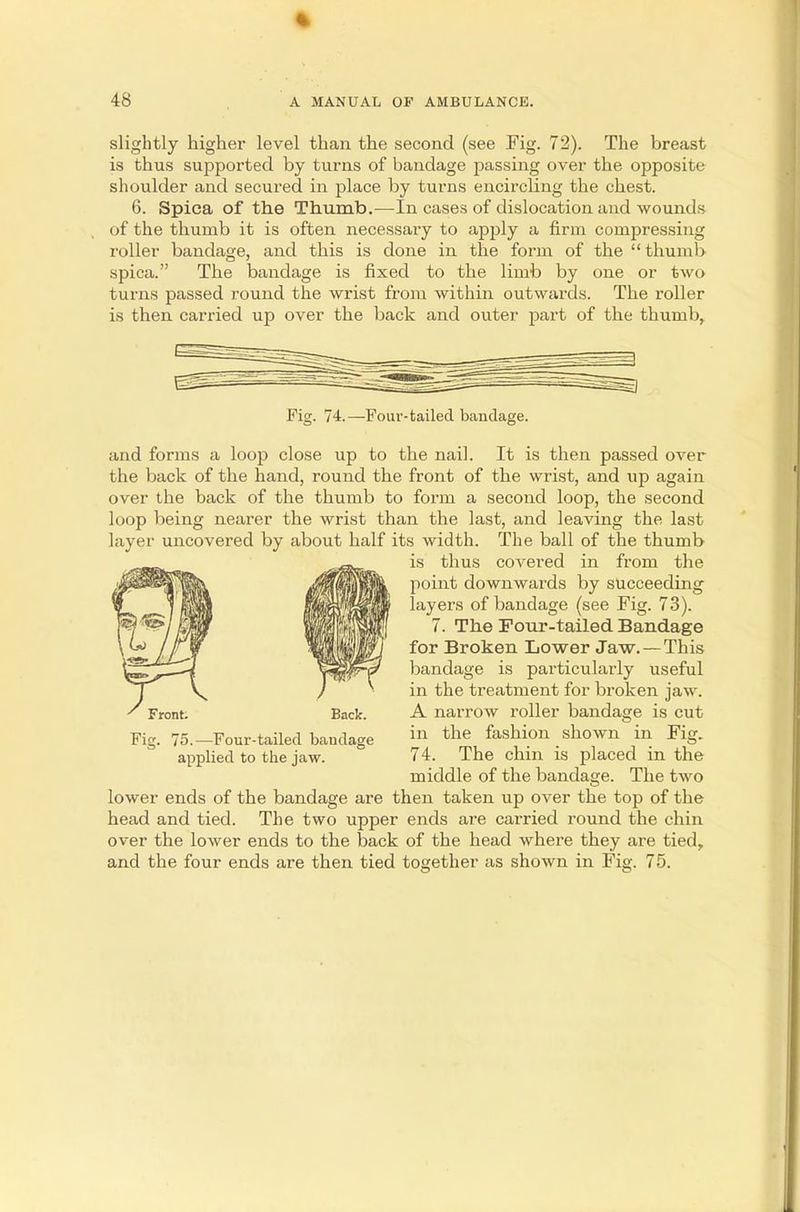 slightly higher level than the second (see Fig. 72). The breast is thus supported by turns of bandage passing over the opposite shoulder and secured in place by turns encircling the chest. 6. Spica of the Thumb.—In cases of dislocation and wounds of the thumb it is often necessary to apply a firm compressing roller bandage, and this is done in the form of the thumb spica. The bandage is fixed to the limb by one or two turns passed round the wrist from within outwards. The roller is then carried up over the back and outer part of the thumb, Fig. 74.—Four-tailed bandage. and forms a loop close up to the nail. It is then passed over the back of the hand, round the front of the wrist, and up again over the back of the thumb to form a second loop, the second loop being nearer the wrist than the last, and leaving the last layer uncovered by about half its width. The ball of the thumb is thus covered in from the point downwards by succeeding layers of bandage (see Fig. 73). 7. The Four-tailed Bandage for Broken Lower Jaw. — This bandage is particularly useful in the treatment for broken jaw. A narrow roller bandage is cut in the fashion shown in Fig. 74. The chin is placed in the middle of the bandage. The two lower ends of the bandage are then taken up over the top of the head and tied. The two upper ends are carried round the chin over the lower ends to the back of the head where they are tied, and the four ends are then tied together as shown in Fig. 75. Front; Back. Fig. 75.—Four-tailed bandage applied to the jaw.