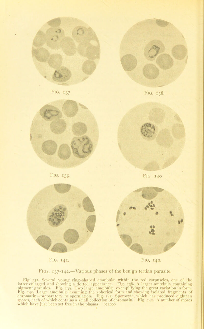 1 Fig. 137. Fig. 138. Fig. 139. Fig. 140 ' A -- ' W * * 1 * 11 V Fig. 141. „ it m % Fig. 142. Figs. 137-142.—Various phases of the benign tertian parasite. Fig. 137. Several young ring-shaped amcebulae within the red corpuscles, one of the latter enlarged and showing a dotted appearance. Fig. 138. A larger amoebula containing pigment granules. Fig. 139. Two large amoebula:, exemplifying the great variation in form. Fig. 140. Large amcebulae assuming the spherical form and showing isolated fragments of chromatin—preparatory to sporulation. Fig. 141. Sporocyte, which has produced eighteen spores, each of which contains a small collection of chromatin. Fig. 142. A number of spores which have just been set free in the plasma. X 1000.