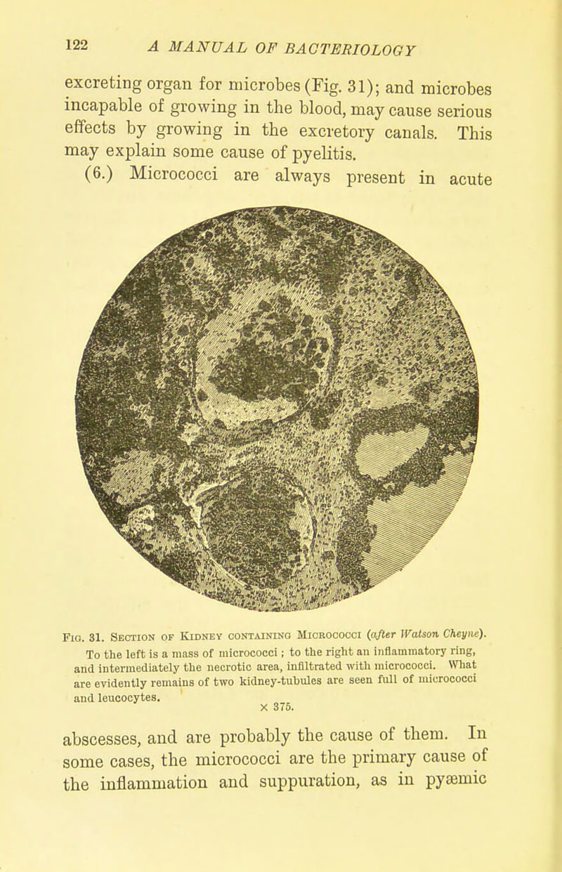 excreting organ for microbes (Fig. 31); and microbes incapable of growing in the blood, may cause serious effects by growing in the excretory canals. This may explain some cause of pyelitis, (6.) Micrococci are always present in acute Fig. 31. Section of Kidney containing Micrococci {ajter Watson Cheyne). To the left is a mass of micrococci; to the right an inflammatory ring, and intermediately the necrotic area, infiltrated with micrococci. What are evidently remains of two kidney-tubules are seen full of micrococci and leucocytes. X 375. abscesses, and are probably the cause of them. In some cases, the micrococci are the primary cause of the inflammation and suppuration, as in pysemic