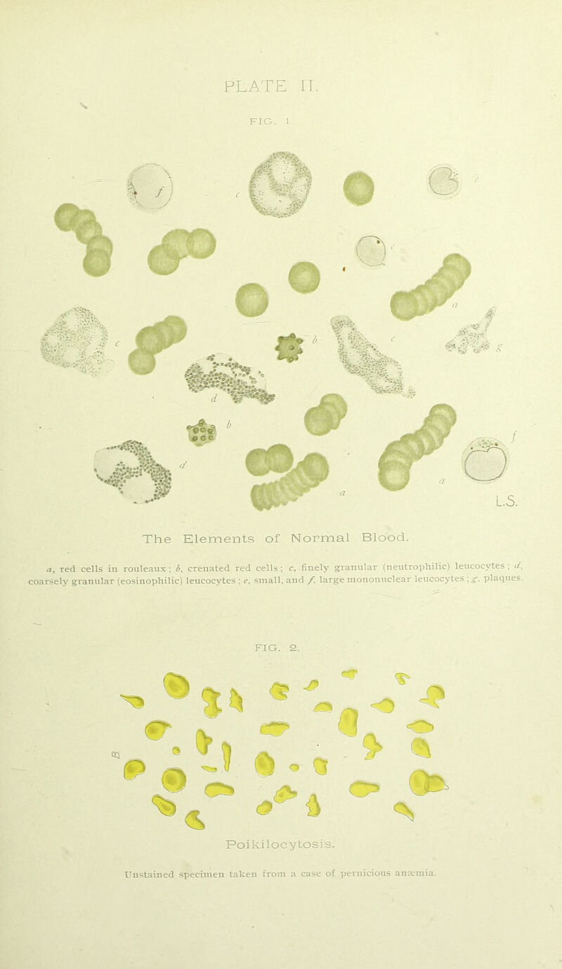 FIG. I. f .iCV ,t;w» V' *X$l i eli - - The Elements of Normal Blood. a, red cells in rouleaux; <£, erenated red cells; c, finely granular (neutrophilic) leucocytes; d. coarsely granular (eosinophilic) leucocytes ; e, small, and f. large mononuclear leucocytes ; g, plaques. FIG. 2. Poikiloeytosis. Unstained specimen taken from a case of pernicious anaemia.