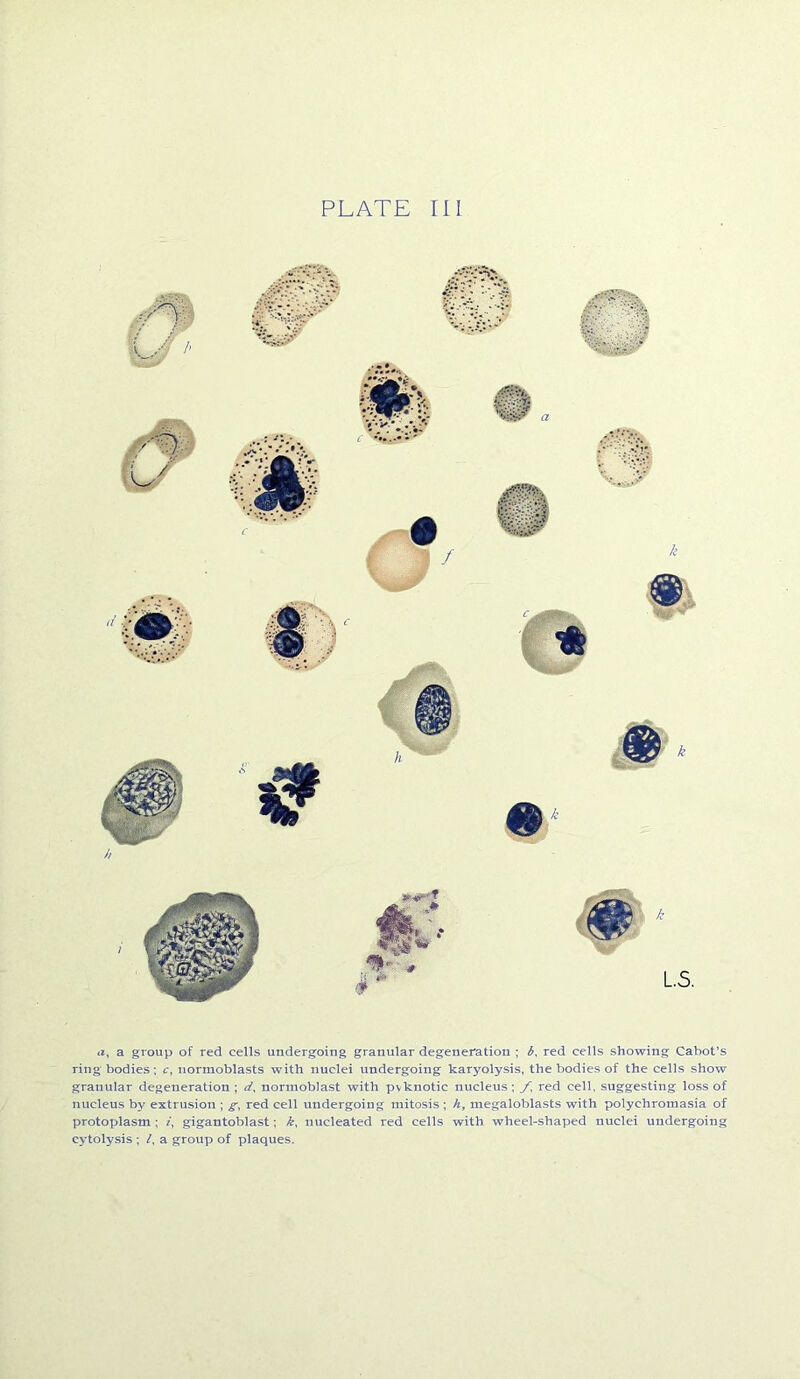 PLATE III a, a group of red cells undergoing granular degeneration ; 6, red cells showing Cabot’s ring bodies; c, normoblasts with nuclei undergoing karyolysis, the bodies of the cells show granular degeneration ; d, normoblast with pvknotic nucleus ; f, red cell, suggesting loss of nucleus by extrusion ; g, red cell undergoing mitosis ; hy megaloblasts with polychromasia of protoplasm ; z, gigantoblast; k, nucleated red cells with wheel-shaped nuclei undergoing cytolysis ; /, a group of plaques.