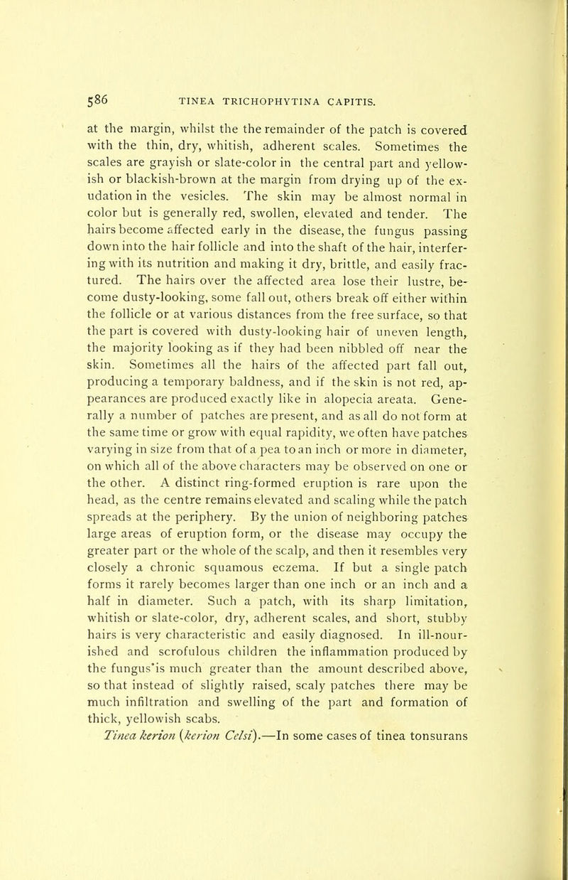 at the margin, whilst the the remainder of the patch is covered with the thin, dry, whitish, adherent scales. Sometimes the scales are grayish or slate-color in the central part and yellow- ish or blackish-brown at the margin from drying up of the ex- udation in the vesicles. The skin may be almost normal in color but is generally red, swollen, elevated and tender. The hairs become affected early in the disease, the fungus passing down into the hair follicle and into the shaft of the hair, interfer- ing with its nutrition and making it dry, brittle, and easily frac- tured. The hairs over the affected area lose their lustre, be- come dusty-looking, some fall out, others break off either wifhia the follicle or at various distances from the free surface, so that the part is covered with dusty-looking hair of uneven length, the majority looking as if they had been nibbled off near the skin. Sometimes all the hairs of the affected part fall out, producing a temporary baldness, and if the skin is not red, ap- pearances are produced exactly like in alopecia areata. Gene- rally a number of patches are present, and as all do notform at the same time or grow with equal rapidity, we often have patches varying in size from that of a pea to an inch or more in diameter, on which all of the above characters may be observed on one or the other. A distinct ring-formed eruption is rare upon the head, as the centre remains elevated and scaling while the patch spreads at the periphery. By the union of neighboring patches large areas of eruption form, or the disease may occupy the greater part or the whole of the scalp, and then it resembles very closely a chronic squamous eczema. If but a single patch forms it rarely becomes larger than one inch or an inch and a half in diameter. Such a patch, with its sharp limitation^ whitish or slate-color, dry, adherent scales, and short, stubby hairs is very characteristic and easily diagnosed. In ill-nour- ished and scrofulous children the inflammation produced by the fungus'is much greater than the amount described above, so that instead of slightly raised, scaly patches there may be much infiltration and swelling of the part and formation of thick, yellowish scabs. Tinea kerion {kerion Celsi).—In some cases of tinea tonsurans