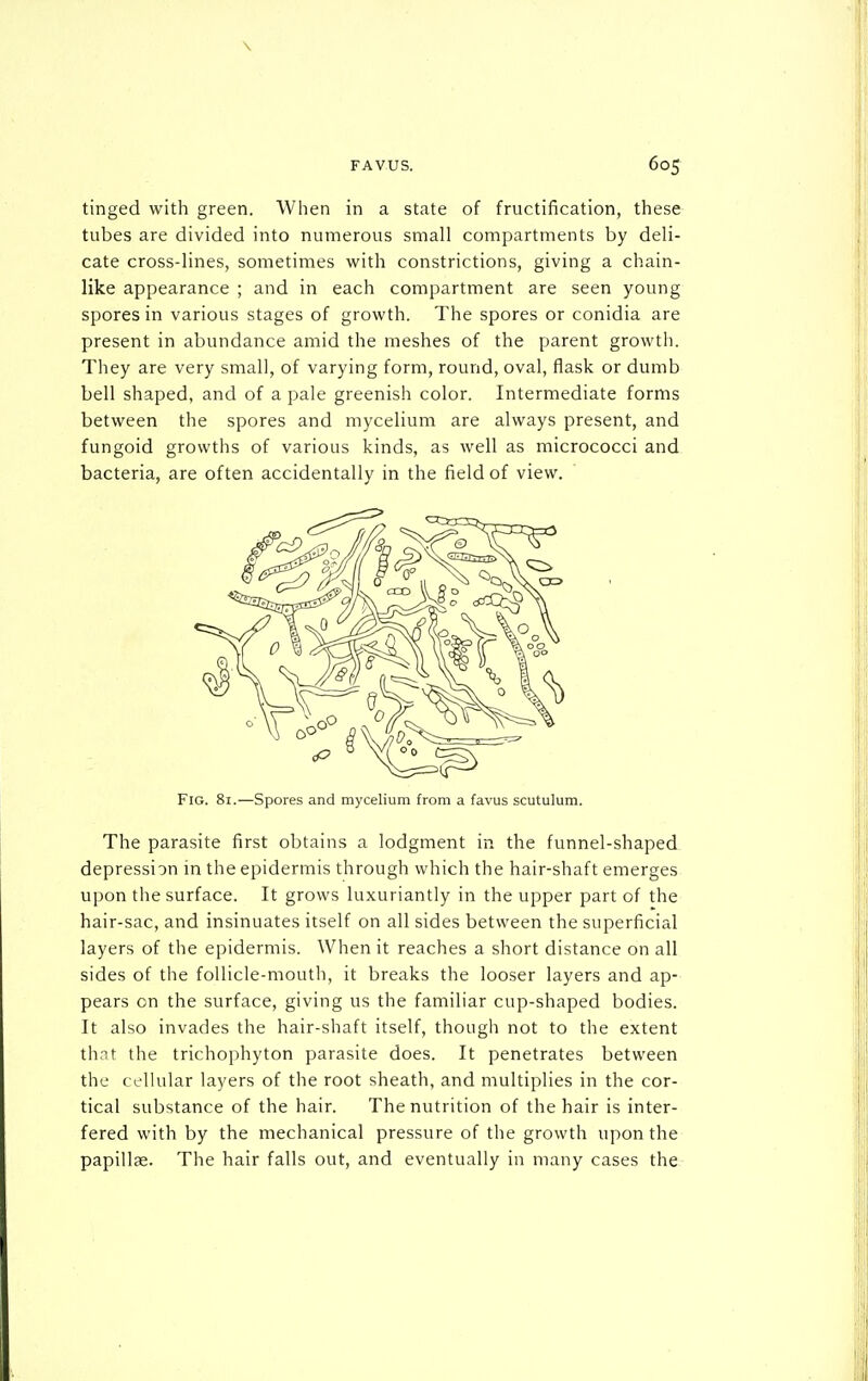tinged with green. When in a state of fructification, these tubes are divided into numerous small compartments by deli- cate cross-lines, sometimes with constrictions, giving a chain- like appearance ; and in each compartment are seen young spores in various stages of growth. The spores or conidia are present in abundance amid the meshes of the parent growth. They are very small, of varying form, round, oval, flask or dumb bell shaped, and of a pale greenish color. Intermediate forms between the spores and mycelium are always present, and fungoid growths of various kinds, as well as micrococci and bacteria, are often accidentally in the field of view. Fig. 81.—Spores and mycelium from a favus scutulum. The parasite first obtains a lodgment in the funnel-shaped depression m the epidermis through which the hair-shaft emerges upon the surface. It grows luxuriantly in the upper part of the hair-sac, and insinuates itself on all sides between the superficial layers of the epidermis. When it reaches a short distance on all sides of the follicle-mouth, it breaks the looser layers and ap- pears on the surface, giving us the familiar cup-shaped bodies. It also invades the hair-shaft itself, though not to the extent thnt the trichophyton parasite does. It penetrates between the cellular layers of the root sheath, and multiplies in the cor- tical substance of the hair. The nutrition of the hair is inter- fered with by the mechanical pressure of the growth upon the papillae. The hair falls out, and eventually in many cases the