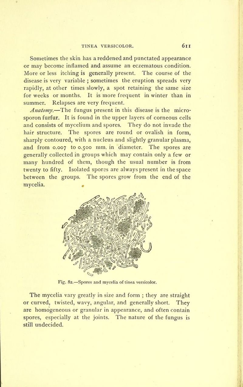 Sometimes the skin has a reddened and punctated appearance or may become inflamed and assume an eczematous condition. More or less itching is generally present. The course of the disease is very variable ; sometimes the eruption spreads very rapidly, at otlier times slowly, a spot retaining the same size for weeks or months. It is more frequent in winter than in summer. Relapses are very frequent. Anatomy.—The fungus present in this disease is the micro- sporon furfur. It is found in the upper layers of corneous cells and consists of mycelium and spores. They do not invade the hair structure. The spores are round or ovalish in form, sharply contoured, with a nucleus and slightly granular plasma, and from 0.007 to 0.500 mm. in diameter. The spores are generally collected in groups which may contain only a few or many hundred of them, though the usual number is from twenty to fifty. Isolated spores are always present in the space between the groups. The spores grow from the end of the mycelia. « Fig. 82.—Spores and mycelia of tinea versicolor. The mycelia vary greatly in size and form ; they are straight or curved, twisted, wavy, angular, and generally short. They are homogeneous or granular in appearance, and often contain spores, especially at the joints. The nature of the fungus is still undecided.