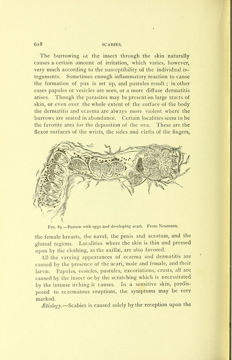 The burrowing ot the insect through the sl<in naturally causes a certain amount of irritation, which varies, however, very much according to the susceptibility of the individual in- teguments. Sometimes enough inflammatory reaction to cause the formation of pus is set up, and pustules result ; in other cases papules or vesicles are seen, or a more diffuse dermatitis arises. Though the parasites may be present on large tracts of skin, or even over the whole extent of the surface of the body the dermatitis and eczema are always more violent where the burrows are seated in abundance. Certain localities seem to be the favorite area for the deposition of the ova. These are the flexor surfaces of the wrists, the sides and clefts of the fingers, Fig. 85.—Burrow with eggs and developing acari. From Neumann. the female breasts, the navel, the penis and scrotum, and the gluteal regions. Localities where the skin is thin and pressed upon by the clothing, as the axillae, are also favored. All the varying appearances of eczema and dermatitis are caused by the presence of the acari, male and female, and their larvee. Papules, vesicles, pustules, excoriations, crusts, all are caused by the insect or by the scratching which is necessitated by the intense itching it causes. In a sensitive skin, predis- posed to eczematous eruptions, the symptoms may be very marked. £fic>/og}'.—Scabies is caused solely by the reception upon the
