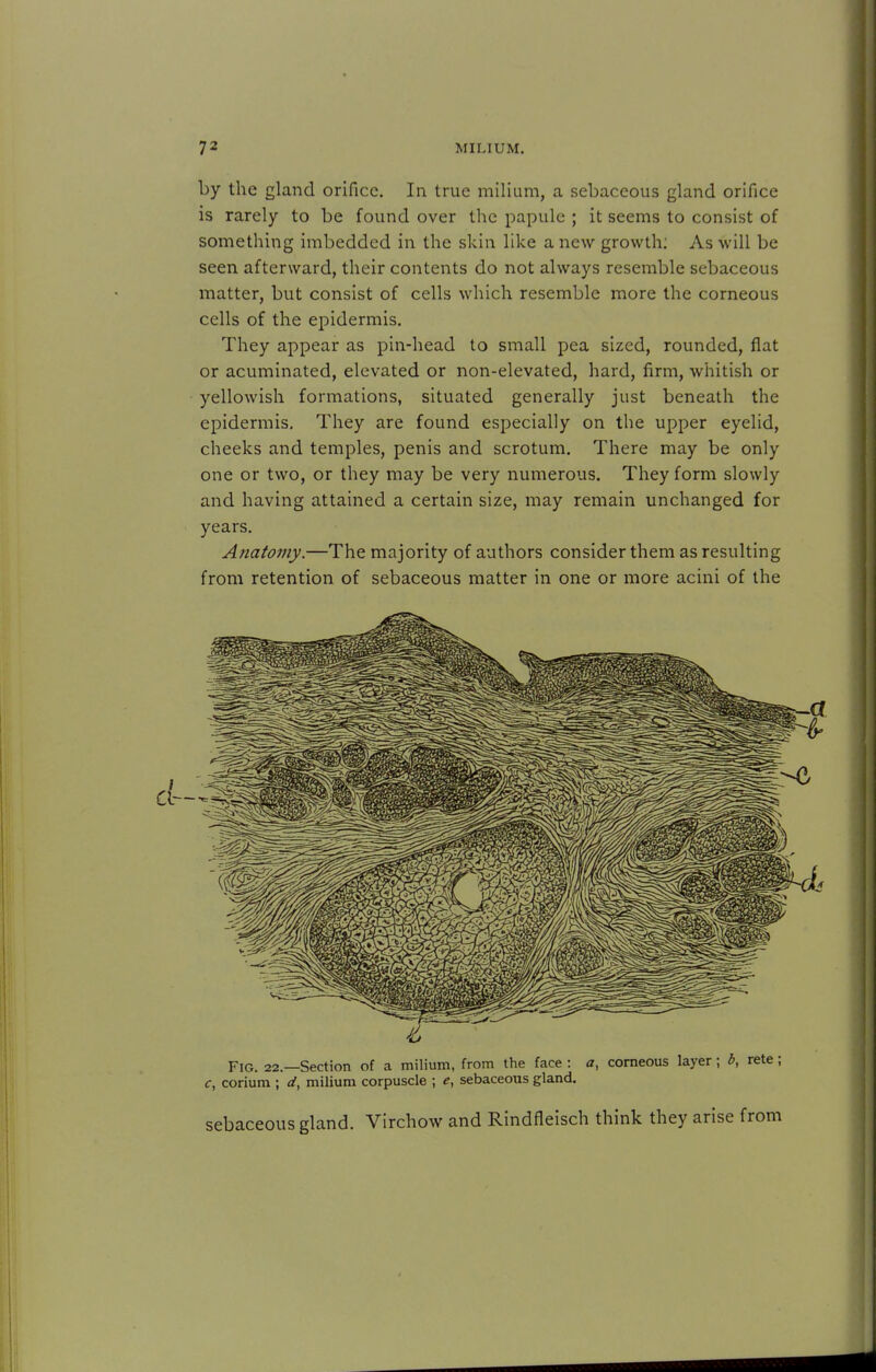 by the gland orifice. In true milium, a sebaceous gland orifice is rarely to be found over the papule ; it seems to consist of something imbedded in the skin like a new growth: As will be seen afterward, their contents do not always resemble sebaceous matter, but consist of cells which resemble more the corneous cells of the epidermis. They appear as pin-head to small pea sized, rounded, flat or acuminated, elevated or non-elevated, hard, firm, whitish or yellowish formations, situated generally just beneath the epidermis. They are found especially on the upper eyelid, cheeks and temples, penis and scrotum. There may be only one or two, or they may be very numerous. They form slowly and having attained a certain size, may remain unchanged for years. Anatomy.—The majority of authors consider them as resulting from retention of sebaceous matter in one or more acini of the Fig. 22.—Section of a milium, from the face : a, corneous layer; 5, c, corium ; d, milium corpuscle ; e, sebaceous gland. sebaceous gland. Virchow and Rindfleisch think they arise from