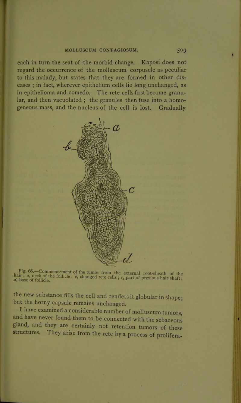 each in turn the seat of the morbid change. Kaposi does not regard the occurrence of the molluscum corpuscle as peculiar to this malady, but states that they are formed in other dis- eases ; in fact, wherever epithelium cells lie long unchanged, as in epithelioma and comedo. The rete cells first become granu- lar, and then vacuolated ; the granules then fuse into a homo- geneous mass, and the nucleus of the cell is lost. Gradually Fig. 66.—Commencement of the tumor from the external root-sheath of the 5h^e offSkle! 5 ' gCd fete CdlS 1 C' Part °f previ°US hair shaft i the new substance fills the cell and renders it globular in shape; but the horny capsule remains unchanged. I have examined a considerable number of molluscum tumors, and have never found them to be connected with the sebaceous gland, and they are certainly not retention tumors of these structures. They arise from the rete by a process of prolifera-