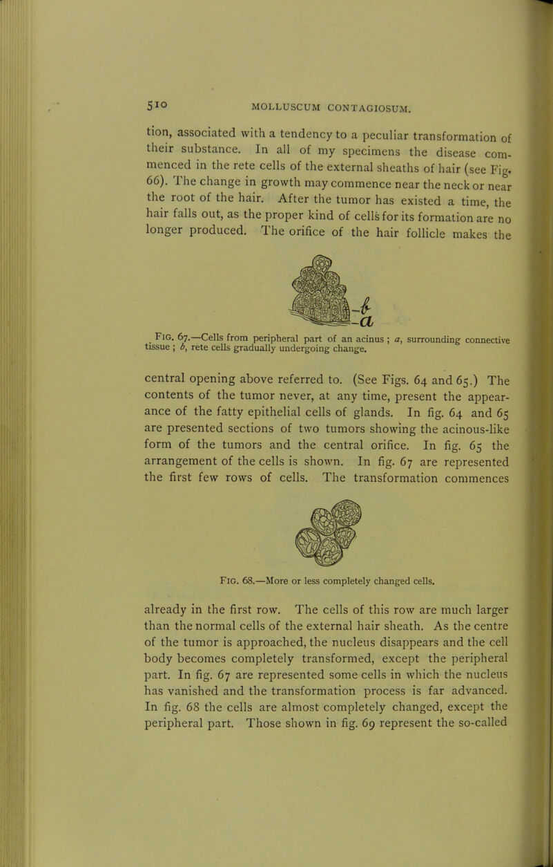 tion, associated with a tendency to a peculiar transformation of their substance. In all of my specimens the disease com- menced in the rete cells of the external sheaths of hair (see Fig. 66). The change in growth may commence near the neck or near the root of the hair. After the tumor has existed a time, the hair falls out, as the proper kind of cells for its formation are no longer produced. The orifice of the hair follicle makes the Fig. 67.—Cells from peripheral part of an acinus ; a, surrounding connective tissue ; d, rete cells gradually undergoing change. central opening above referred to. (See Figs. 64 and 65.) The contents of the tumor never, at any time, present the appear- ance of the fatty epithelial cells of glands. In fig. 64 and 65 are presented sections of two tumors showing the acinous-like form of the tumors and the central orifice. In fig. 65 the arrangement of the cells is shown. In fig. 67 are represented the first few rows of cells. The transformation commences Fig. 68.—More or less completely changed cells. already in the first row. The cells of this row are much larger than the normal cells of the external hair sheath. As the centre of the tumor is approached, the nucleus disappears and the cell body becomes completely transformed, except the peripheral part. In fig. 67 are represented some cells in which the nucleus has vanished and the transformation process is far advanced. In fig. 68 the cells are almost completely changed, except the peripheral part. Those shown in fig. 69 represent the so-called